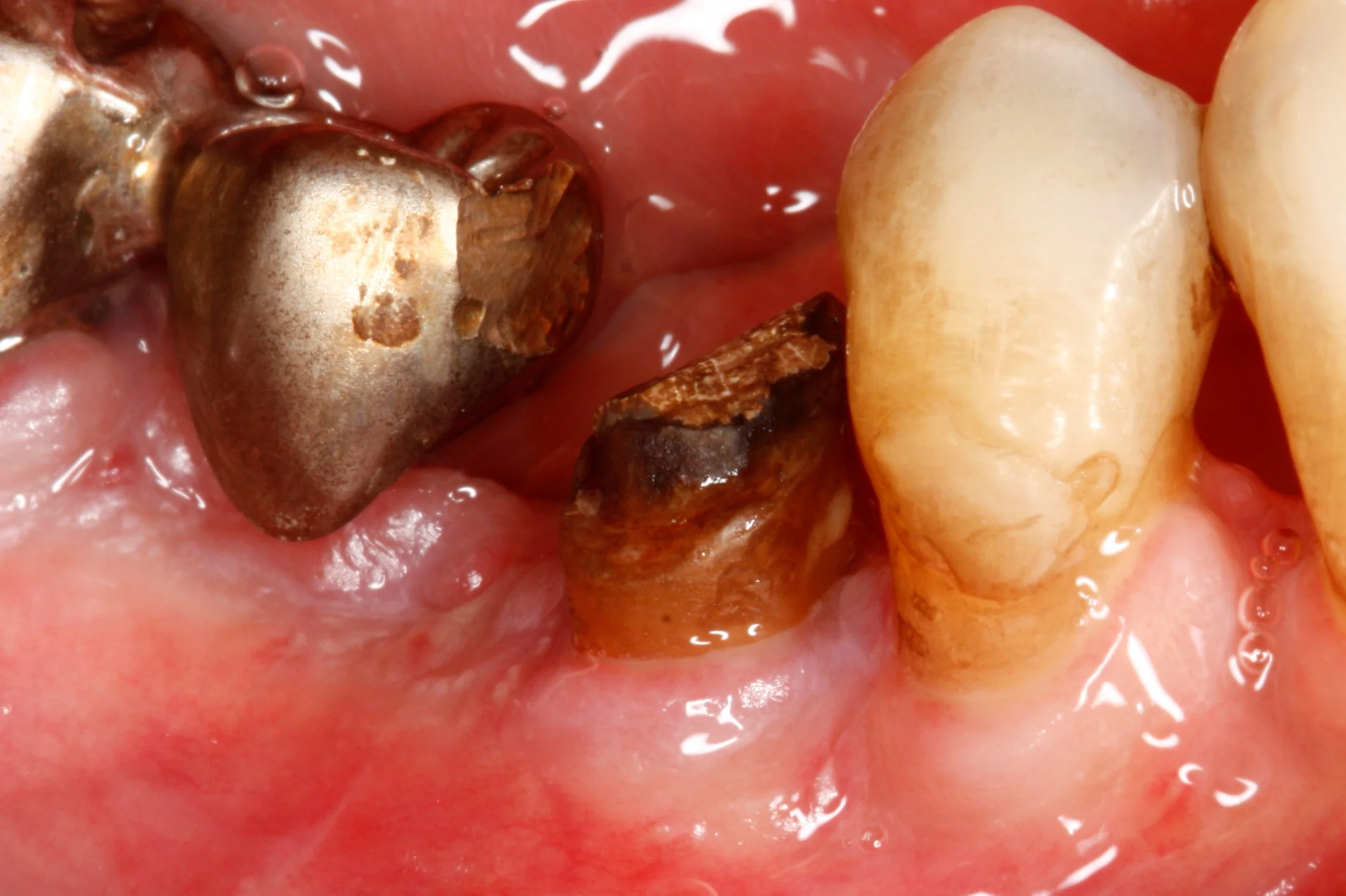 After the crown lengthening procedure, more of the tooth is exposed