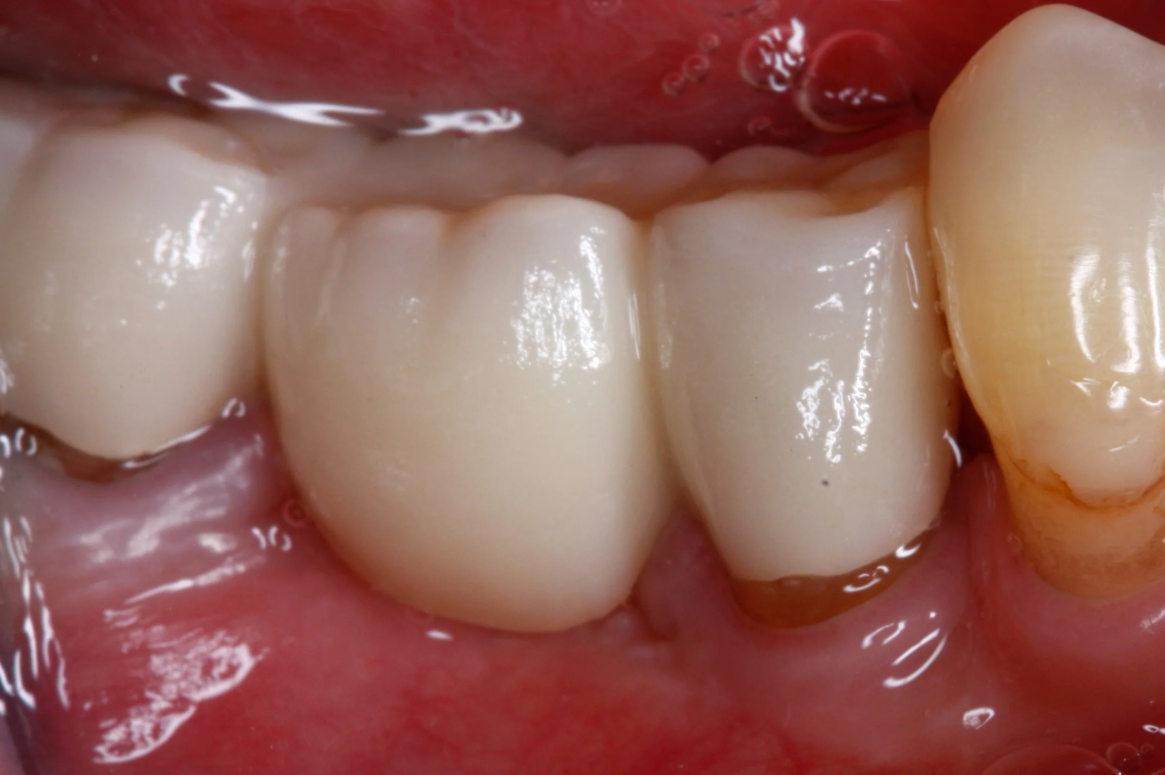 A new bridge is fabricated using the increased tooth structure created by the crown lengthening