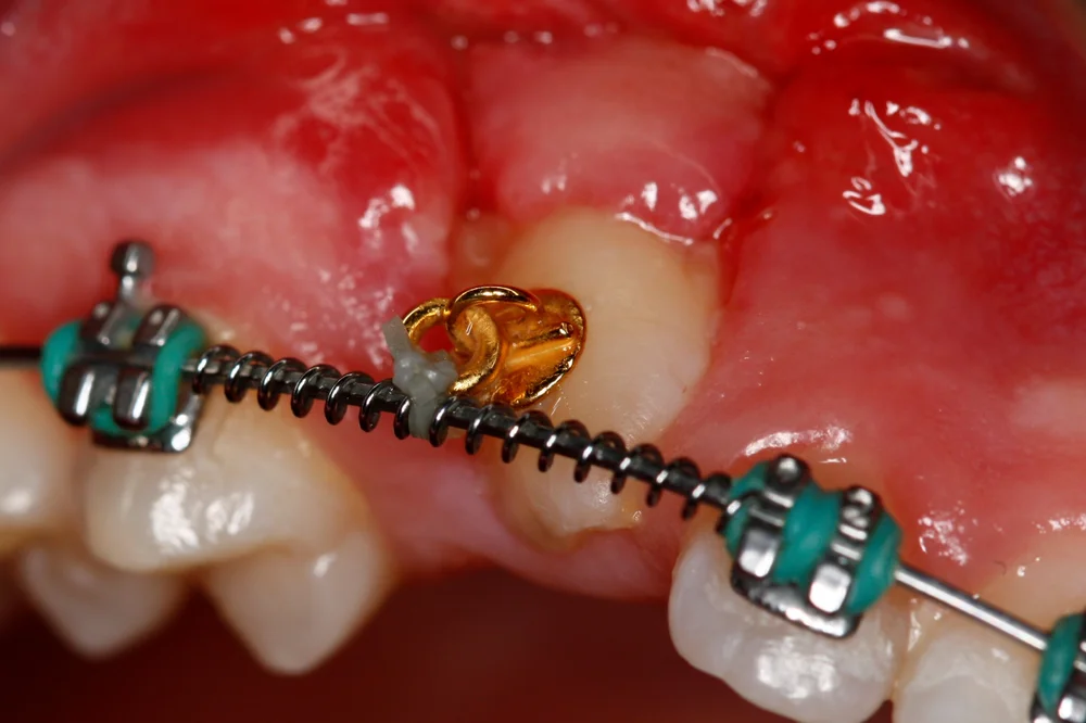 Overall tumor thin dental chains to pull teeth down Fore type Fed up