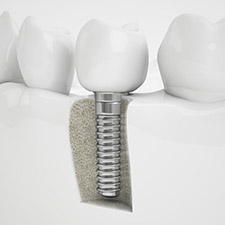 dental implant .jpg