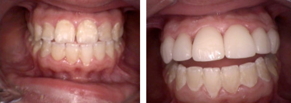 veneers2.png