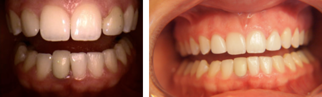 veneers3.png