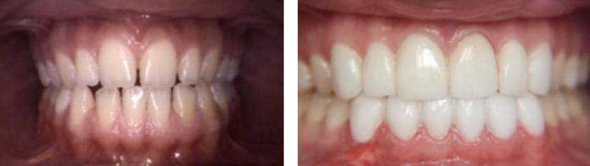 veneers7.png