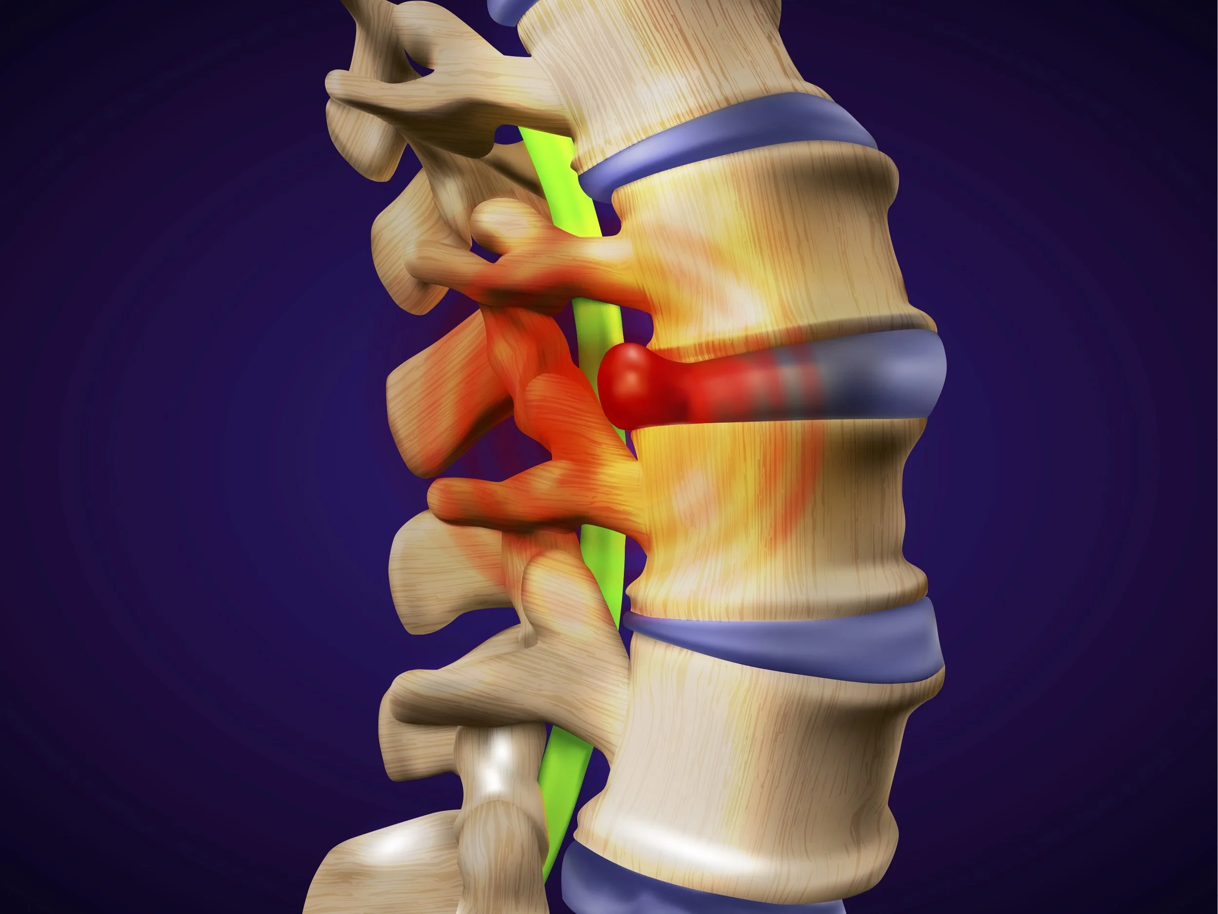 Herniated and prolapsed disc treatment in Bristol