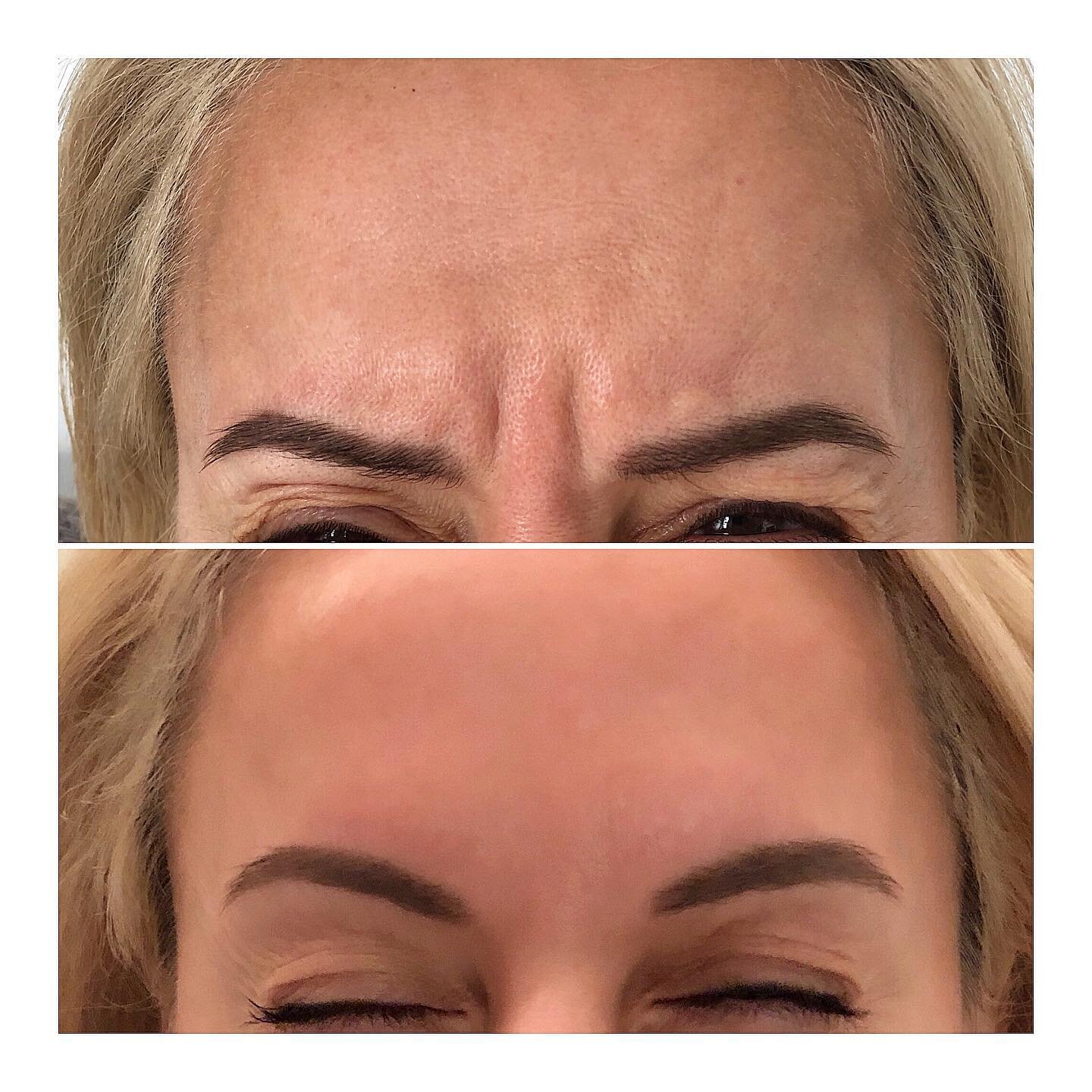 Botox that frown away gals 💉💉💉 - prevention is better than cure!! Botox works over a period of 2 weeks and lasts roughly 4 months. It is used to relax out the fine lines between the brows, across the forehead, and crows feet. It works by freezing 