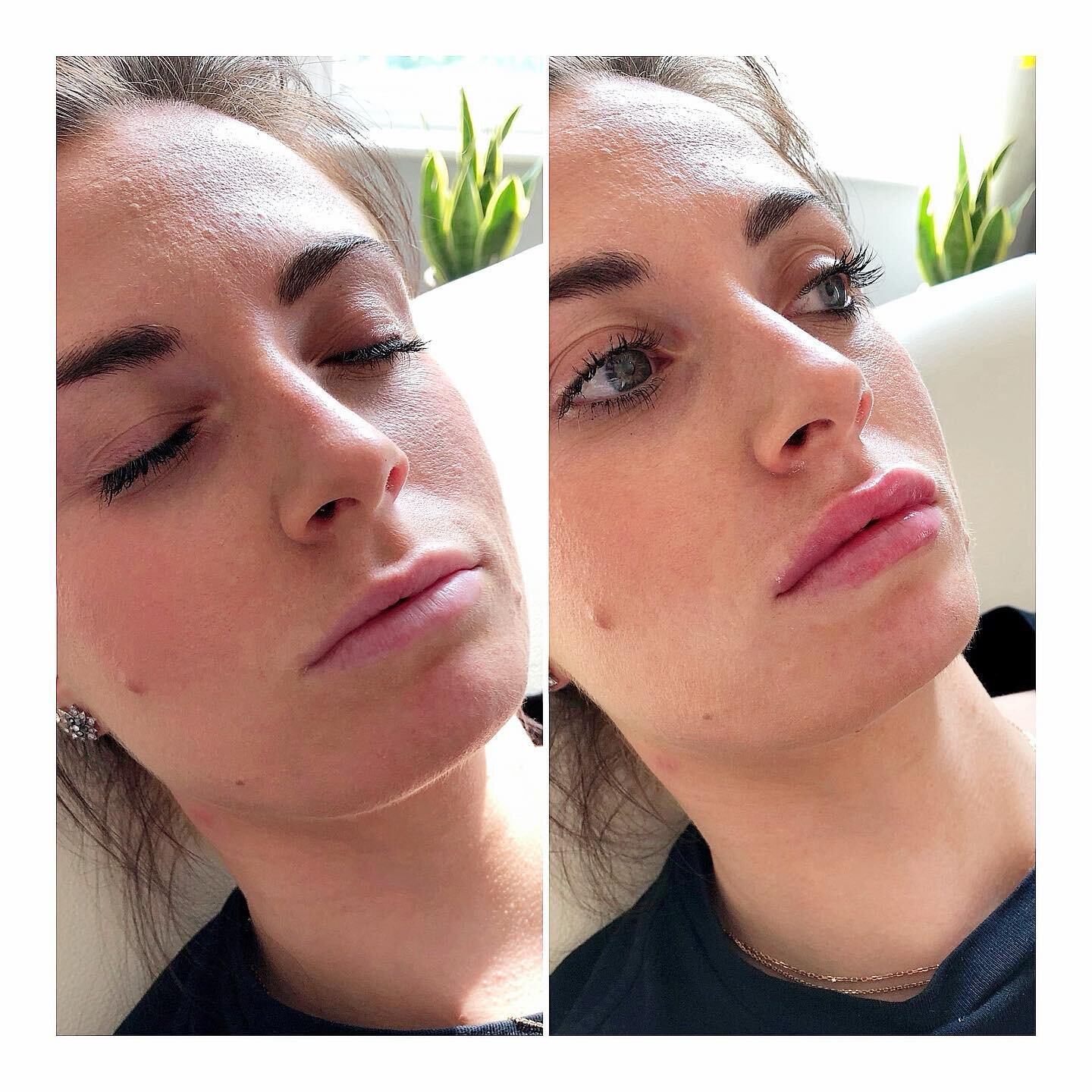 1ml of lip filler for this absolute beauty!!!! We did these lips about three weeks ago, but I&rsquo;ve only just got around to posting. I can&rsquo;t wait to see the final result now everything has softened and settled 😍😍😍💉💉💉 

 #clapham #aesth