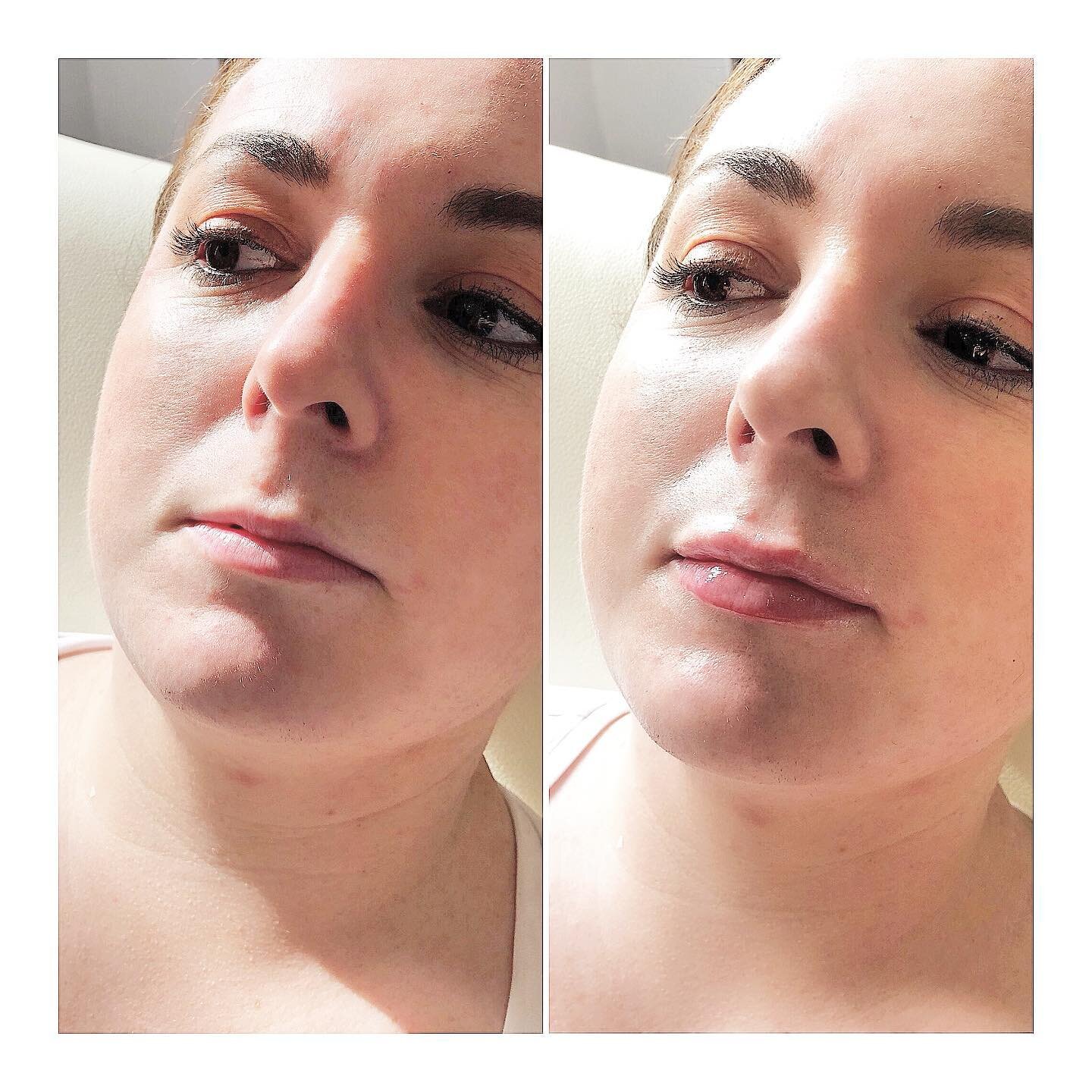 Little plump can make the world of difference 💋💉😍

 #clapham #aesthetics #aesthetic #claphammums #wrinklerelaxinginjections #filler #dermalfiller #battersea #northcoteroad #claphamjunction #nappyvalley #balhammums #lips #doctor #cosnetics #skincar