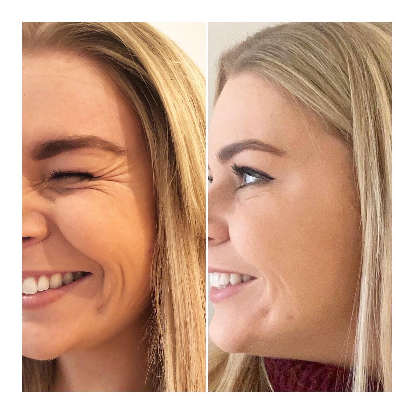 When the #botox kicks in and the smile lines vanish 😍😍 just in time for summer ☀️

 #clapham #aesthetics #aesthetic #claphammums #wrinklerelaxinginjections #filler #dermalfiller #battersea #northcoteroad #claphamjunction #nappyvalley #balhammums #l