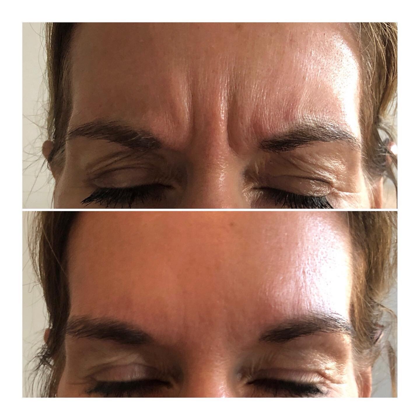 Botox that frown away! 

💉💉💉

#clapham #aesthetics #aesthetic #claphammums #wrinklerelaxinginjections #filler #dermalfiller #battersea #northcoteroad #claphamjunction #nappyvalley #balhammums #lips #doctor #cosnetics #skincare #youth #russianlips 