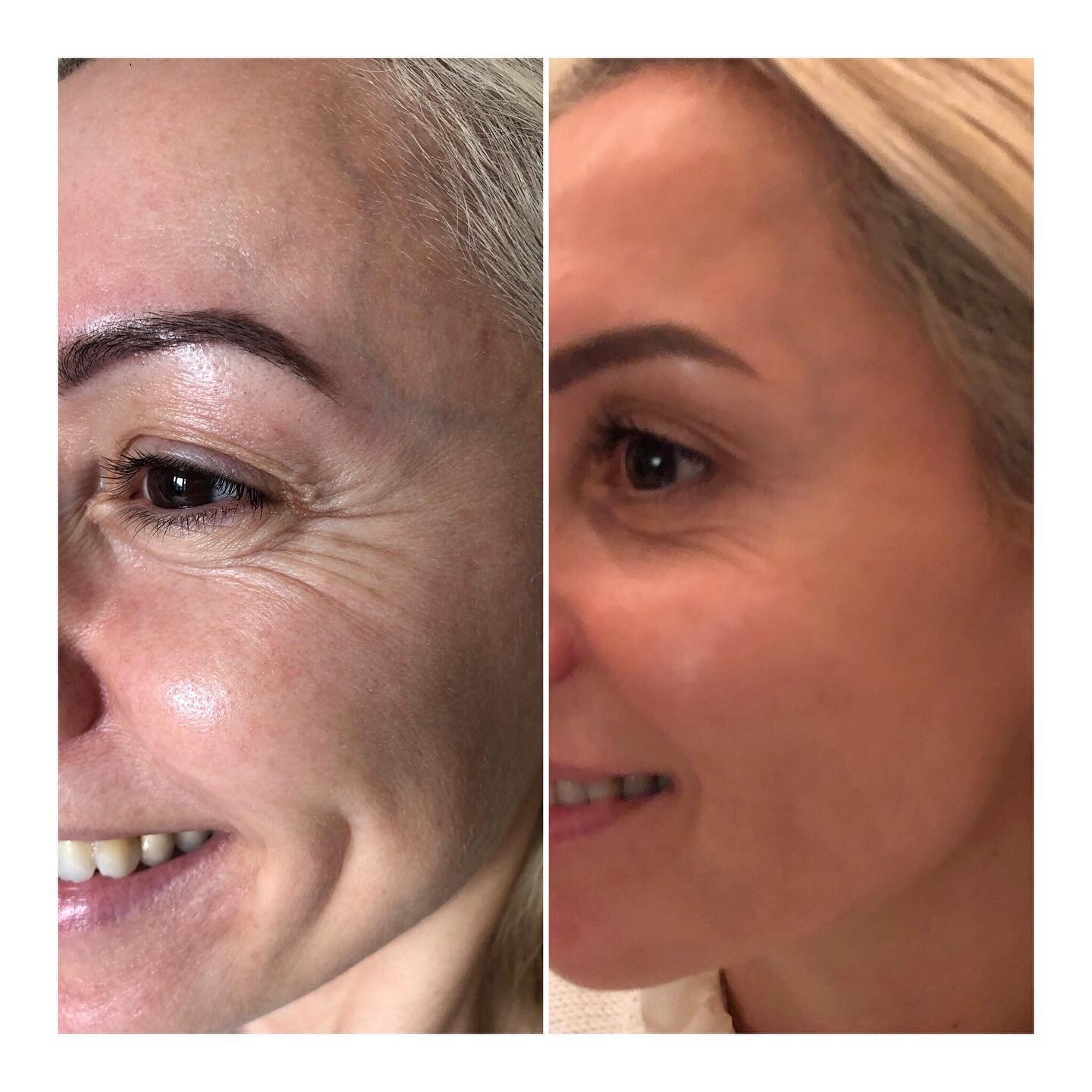 Bye bye crows feet 👋🏻 

The magic of Botox strikes again 😍💪🏼💉

 #clapham #aesthetics #claphamaesthetics #beauty #battersea #botoxclapham #botox #lipsclapham #fillerclapham #batterseaaesthetics #lipsbattersea #botoxbattersea #salon #fillerbatter