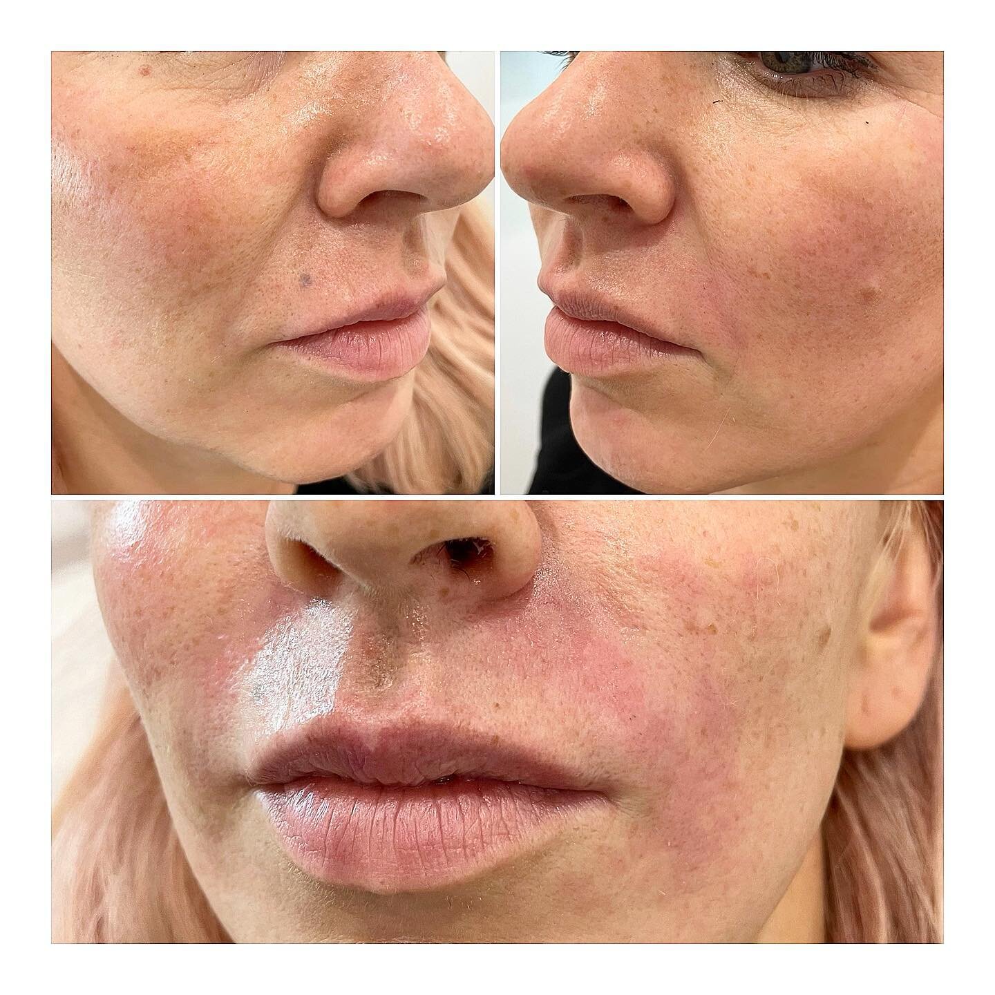Using a very small amount of dermal filler (0.5ml each side) we were able to completely smooth out the nasolabial lines AKA the mouth to nose lines. As we age these folds get deeper and deeper resulting in the face looked aged. By filling these lines