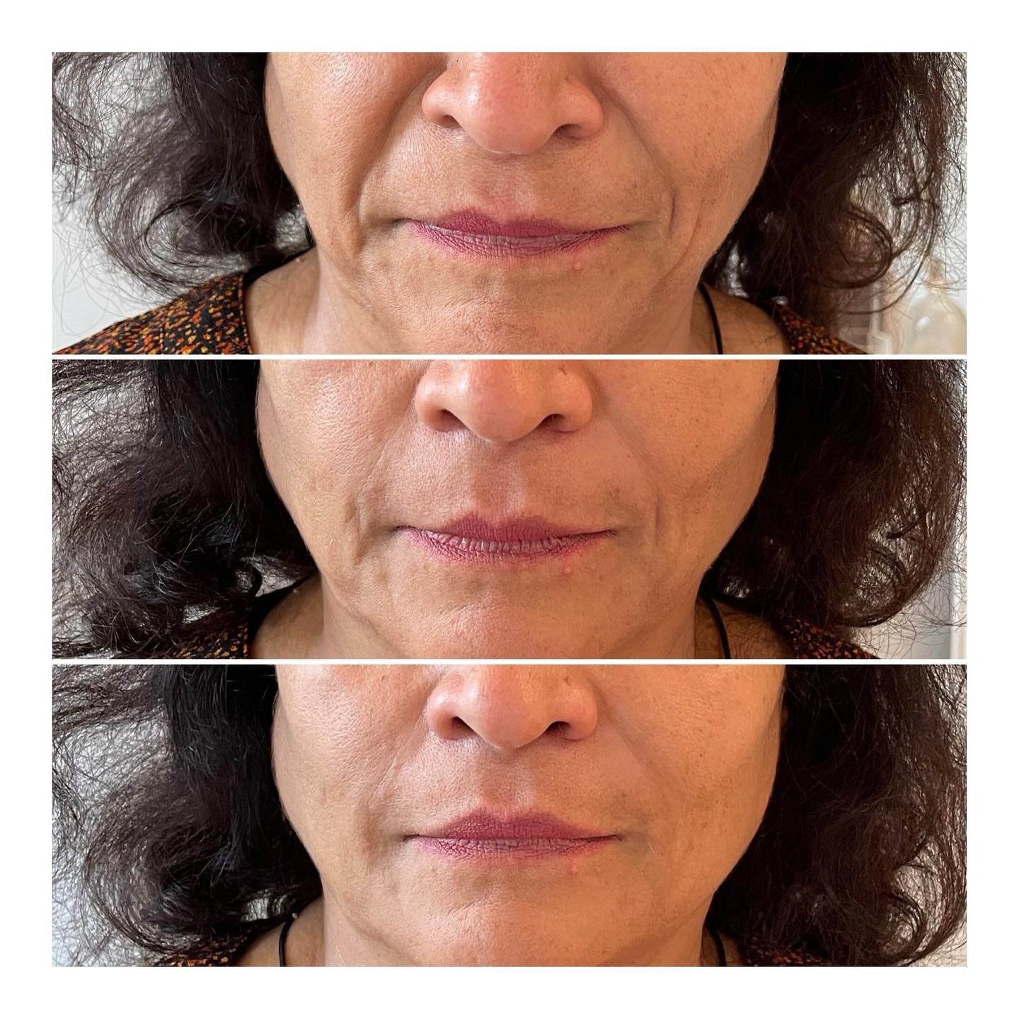 Just LOOK at this transformation!!!! The top picture is pre dermal filler. The middle picture is after 0.5ml either side, and the bottom picture after 1ml total either side. What a huge difference!!!! By treating the nasolabial folds, the entire face