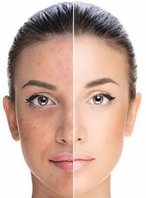 face before and after chemical peel (results will vary)