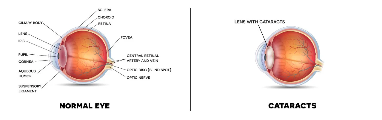 Cataract_Diagram.jpg