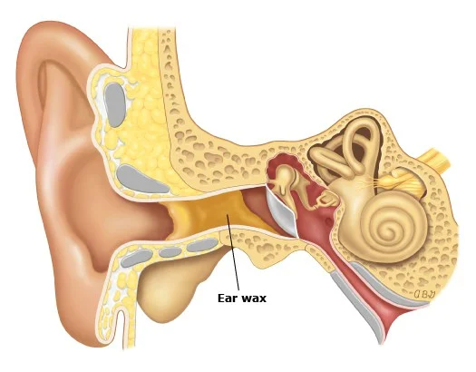 Ear-wax-impaction-PI.jpg