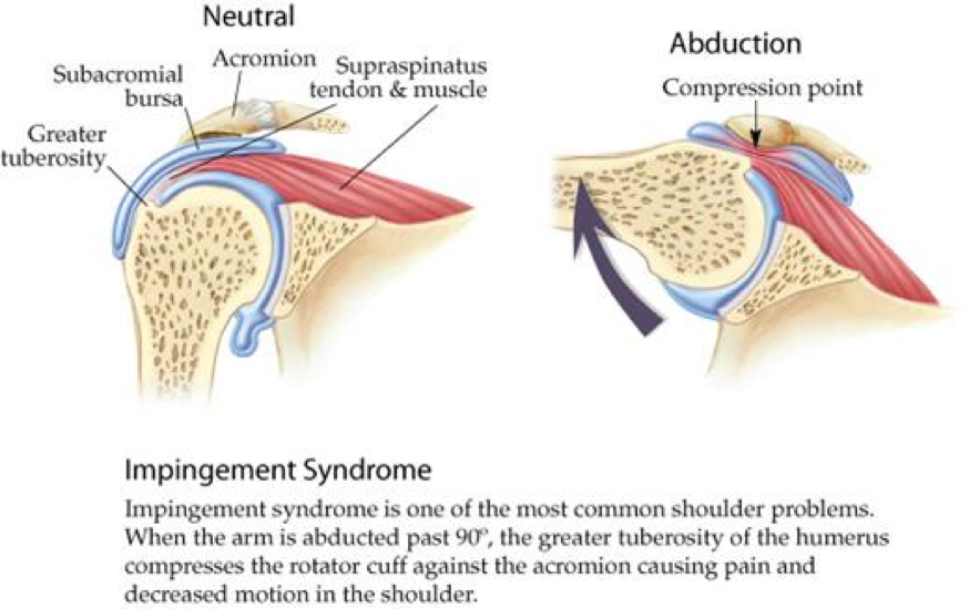 Arthroscopic Sub-Acromial Decompression — Campbell Hand — Shoulder ...