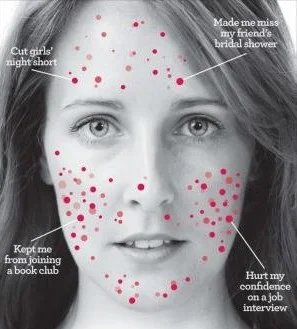 I Tried THIS For My Acne, And It Changed My Life...