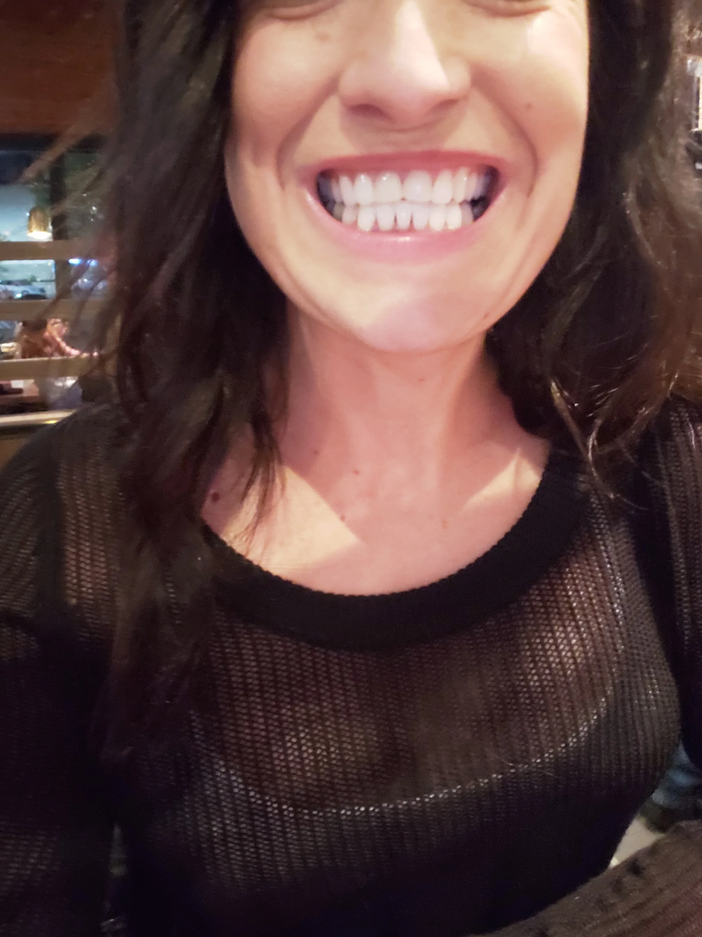 My teeth AFTER Invisalign and BEFORE my permanent teeth were put in - my teeth are still short in the front but the gap closed quite a bit and they were straightened in just months.