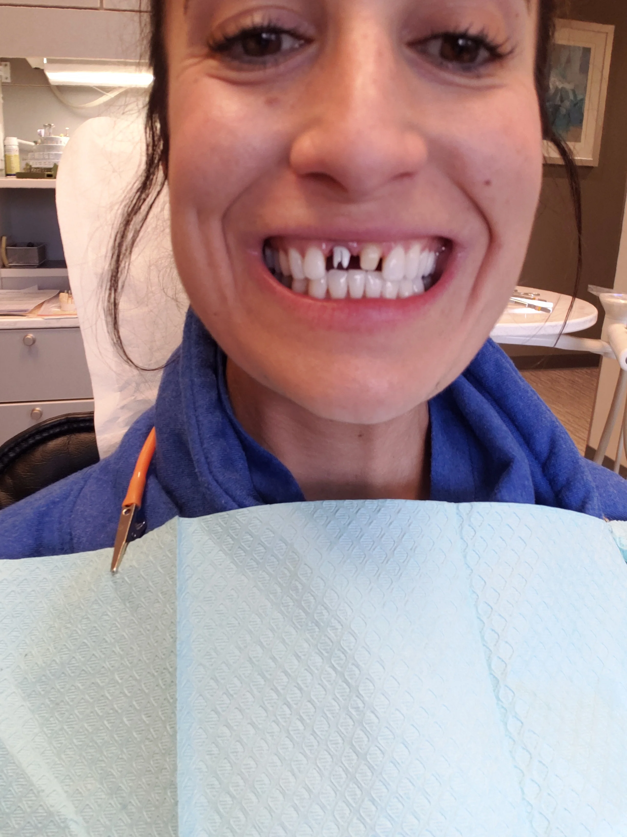 GROSSS! These are what my real tooth and my implant look like without the veneer (which goes over the tooth) and the implant veneer (which goes over the peg looking thing) it was a semi painless process and totally worth it! But not very pretty at all