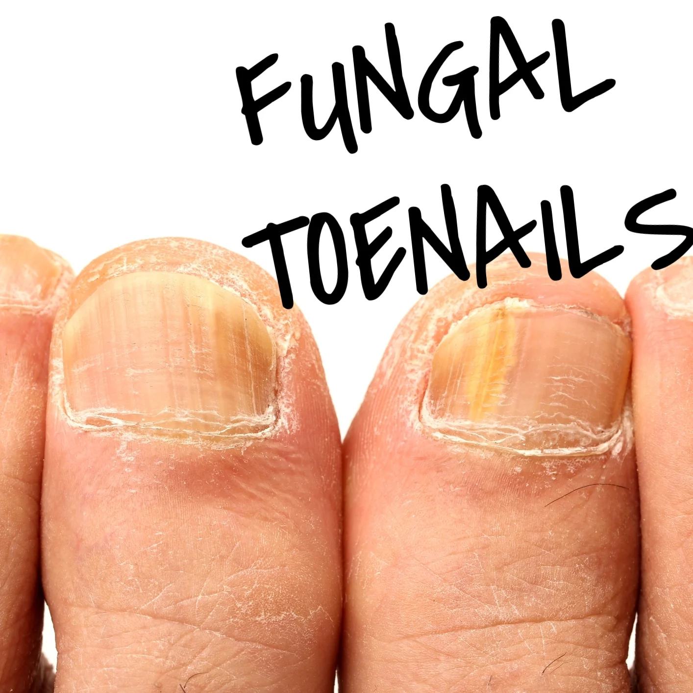 Fungal Toenails