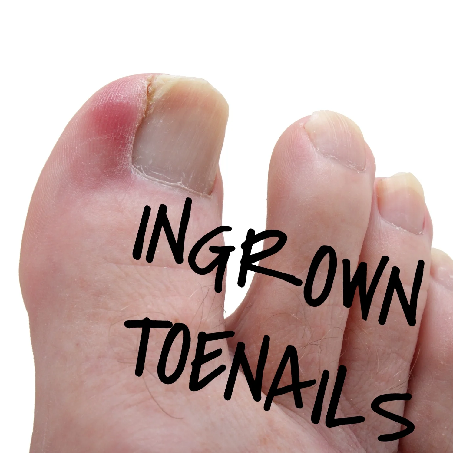 Ingrown Toenails