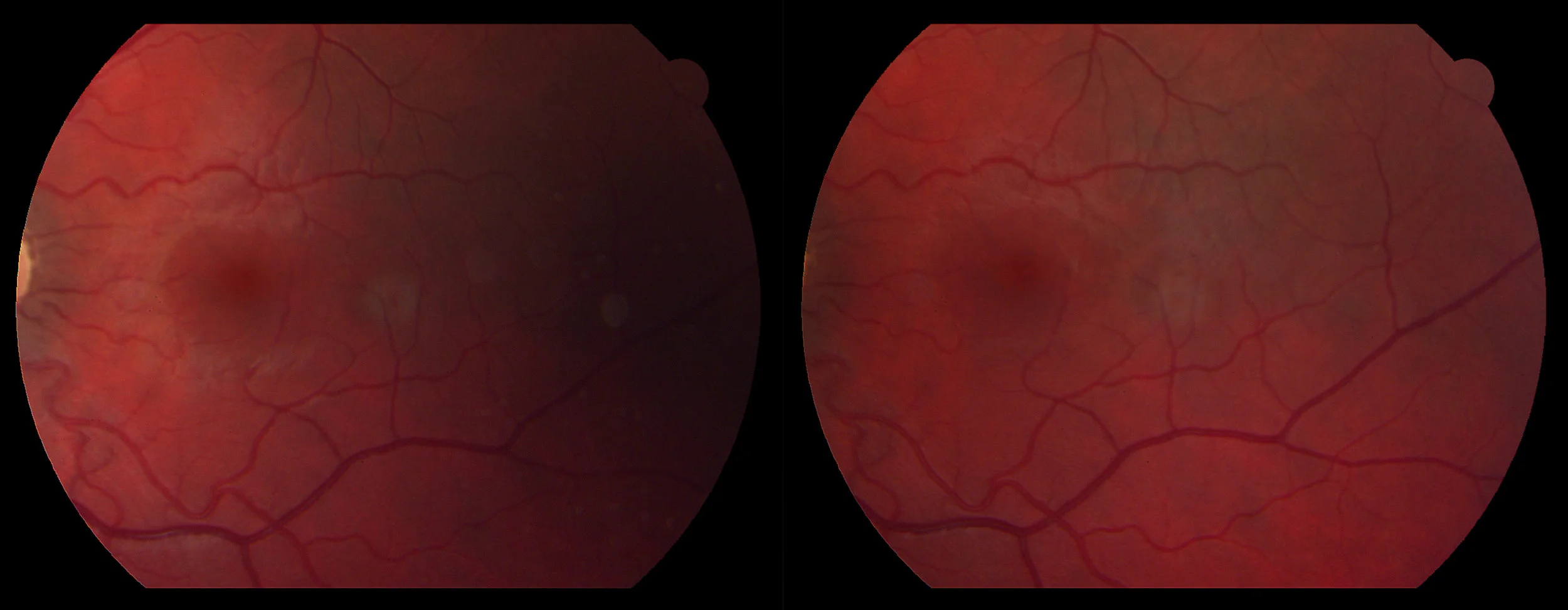 Oculus Sinister: Temporal to Macula