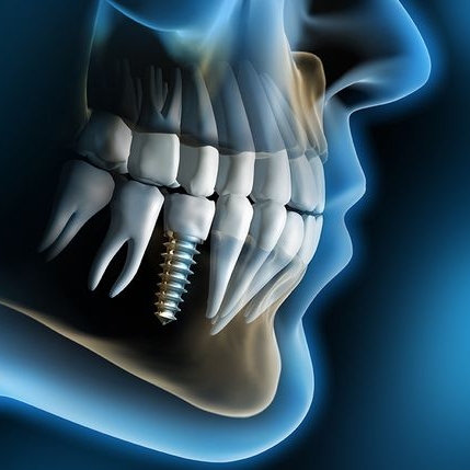 implants.jpg