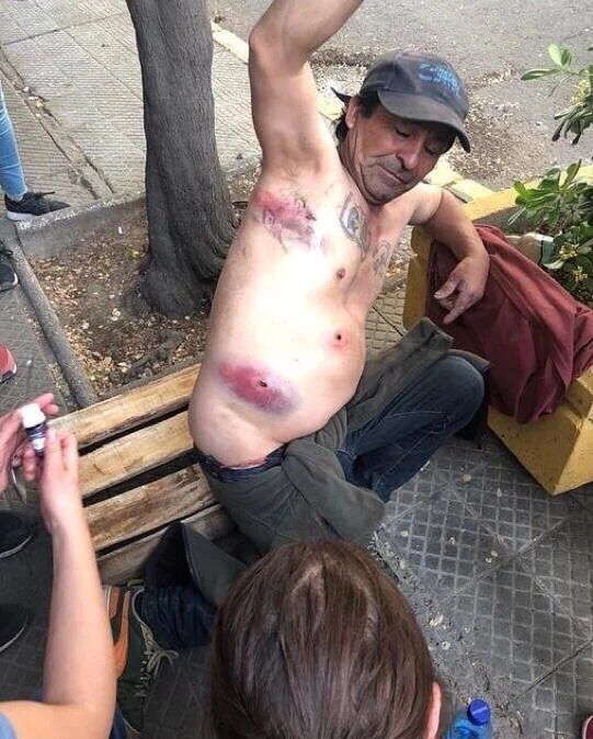  Man injured by “rubber shot” 