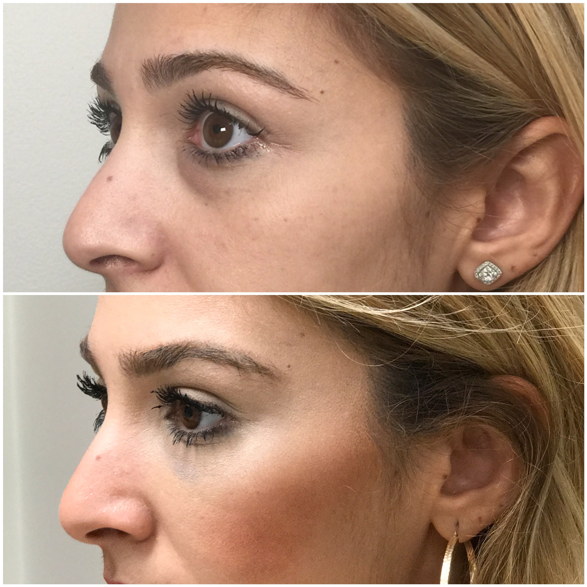 Under Eye Area Treatment and Cheek lift with Filler 