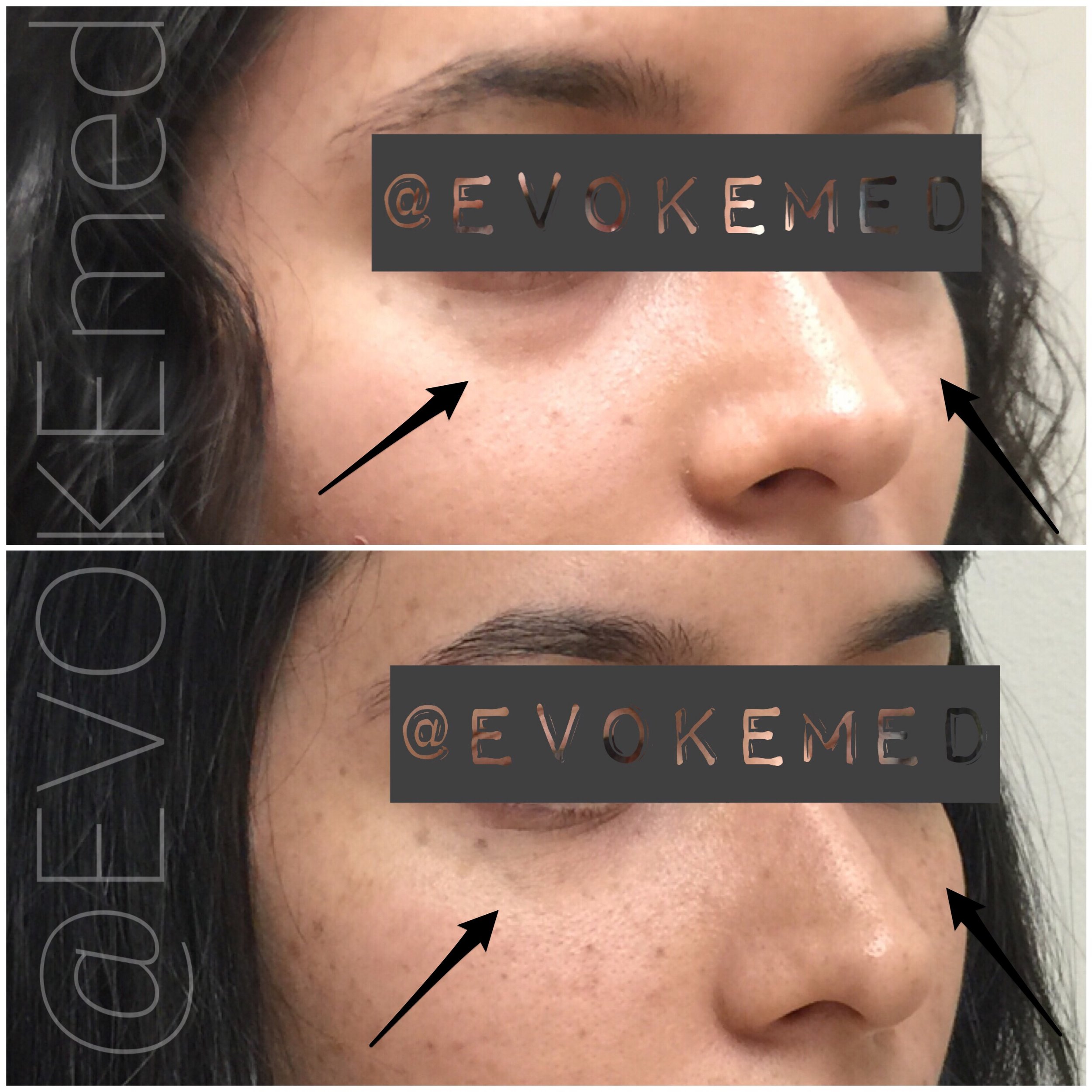 Under Eye Area Correction with Filler