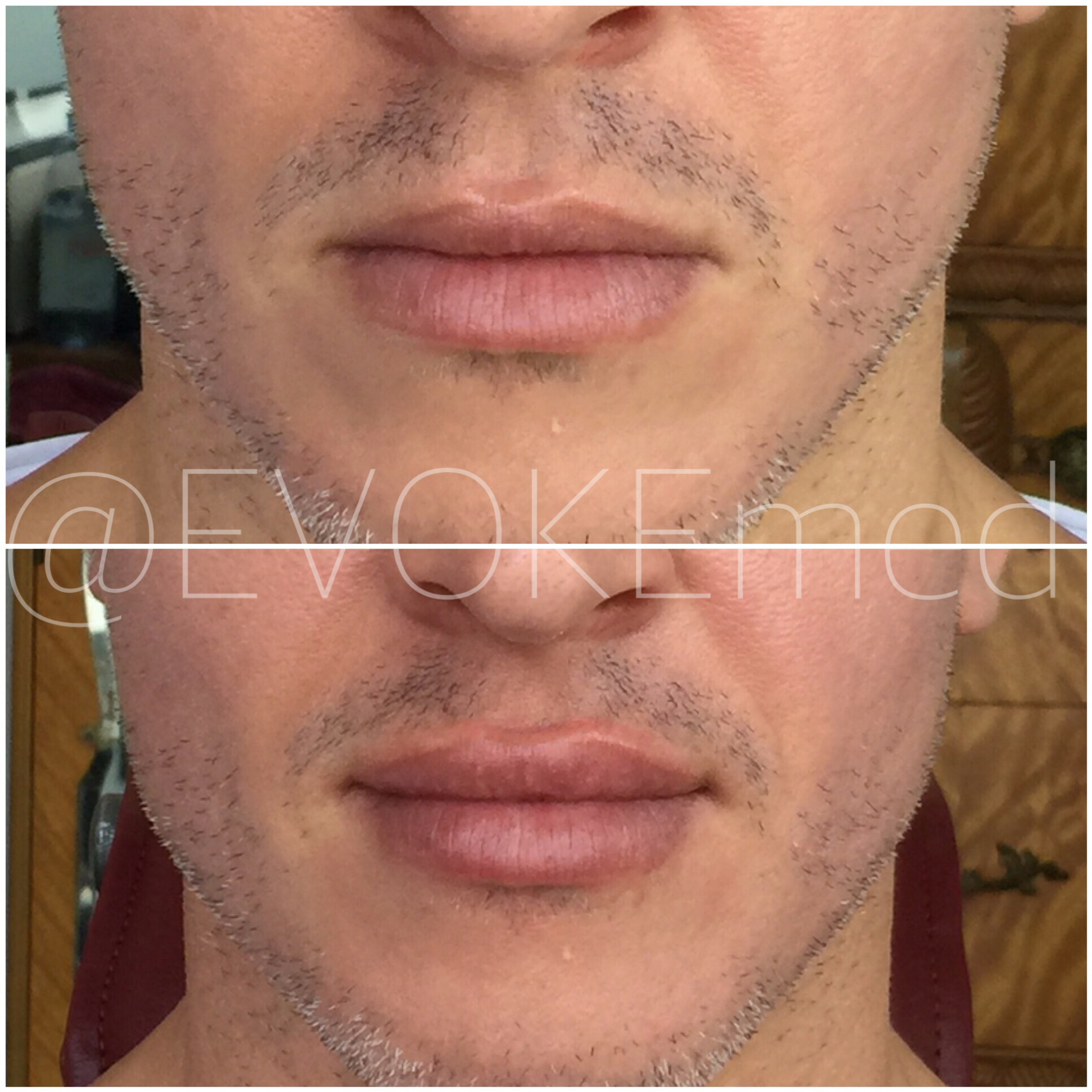 Lip Augmentation with Filler