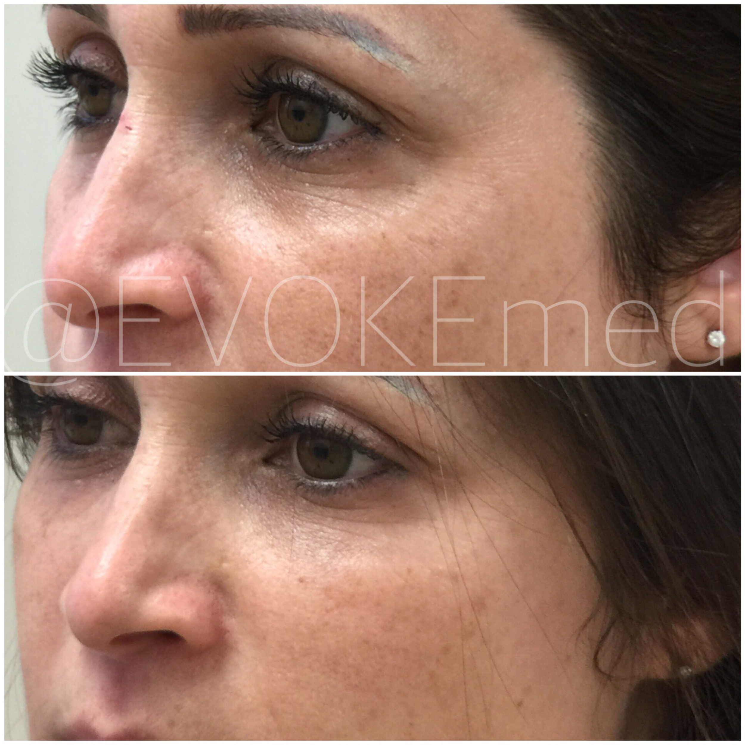 Under Eye Area Correction with Filler