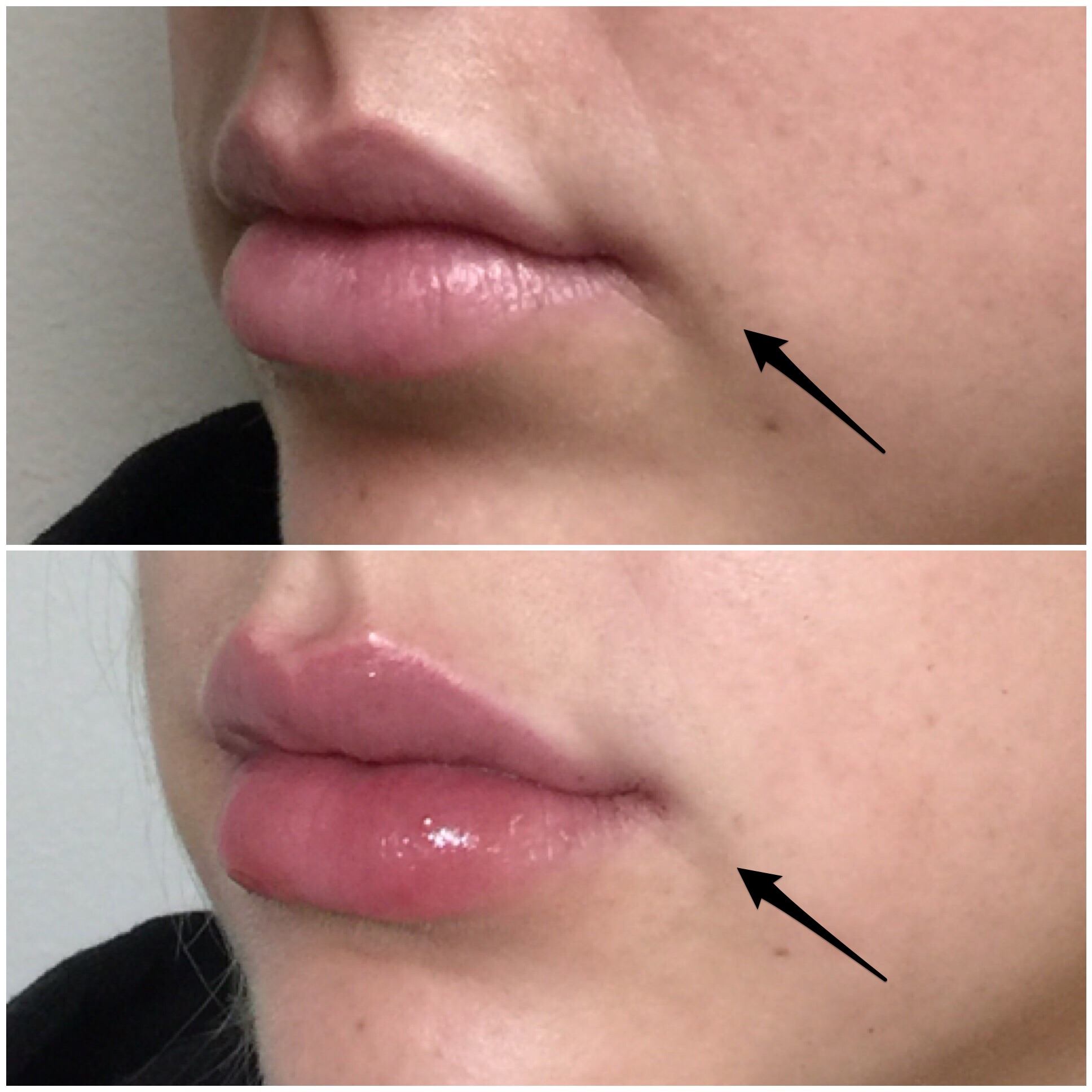 LIp Augmentation with Filler