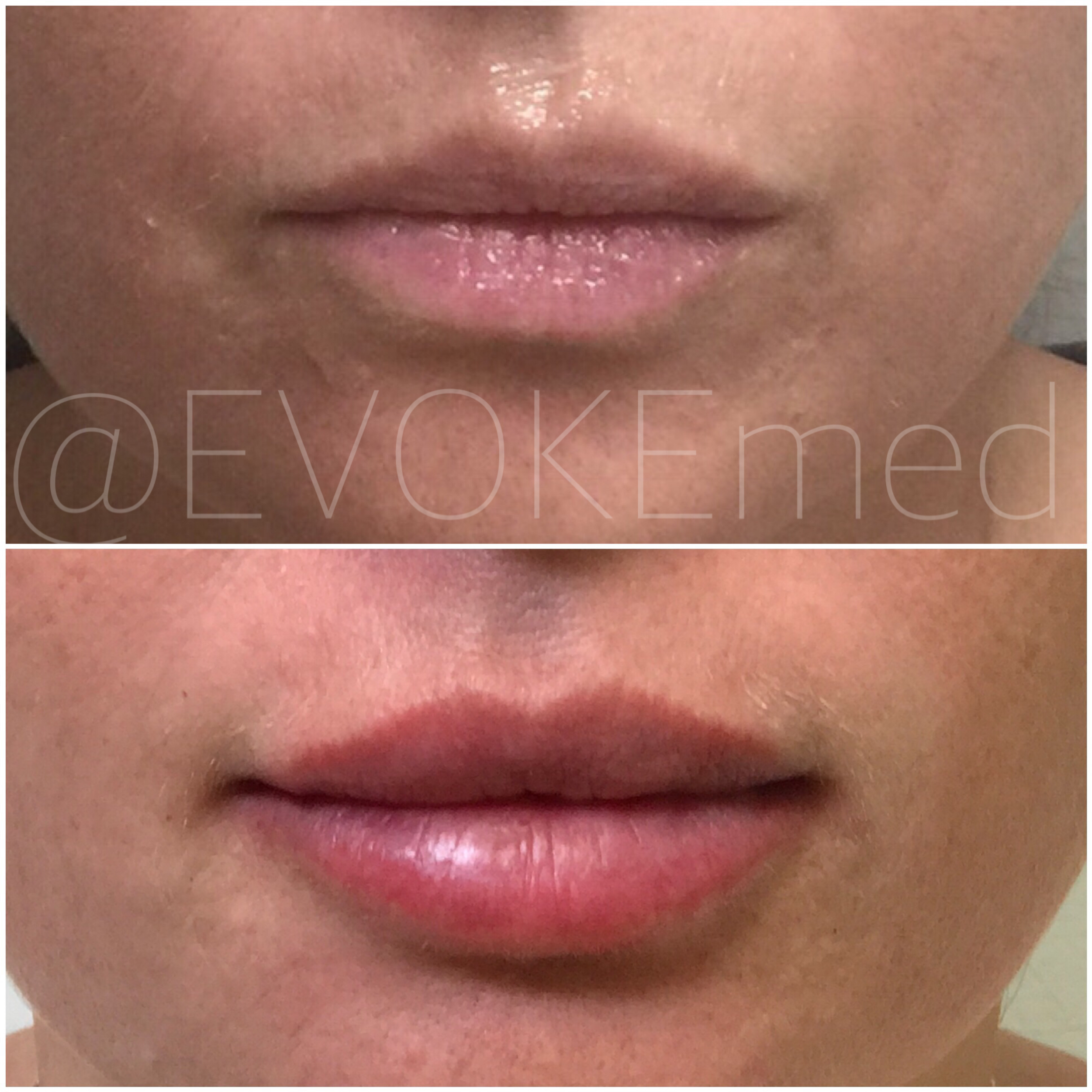 Lip Augmentation with Filler