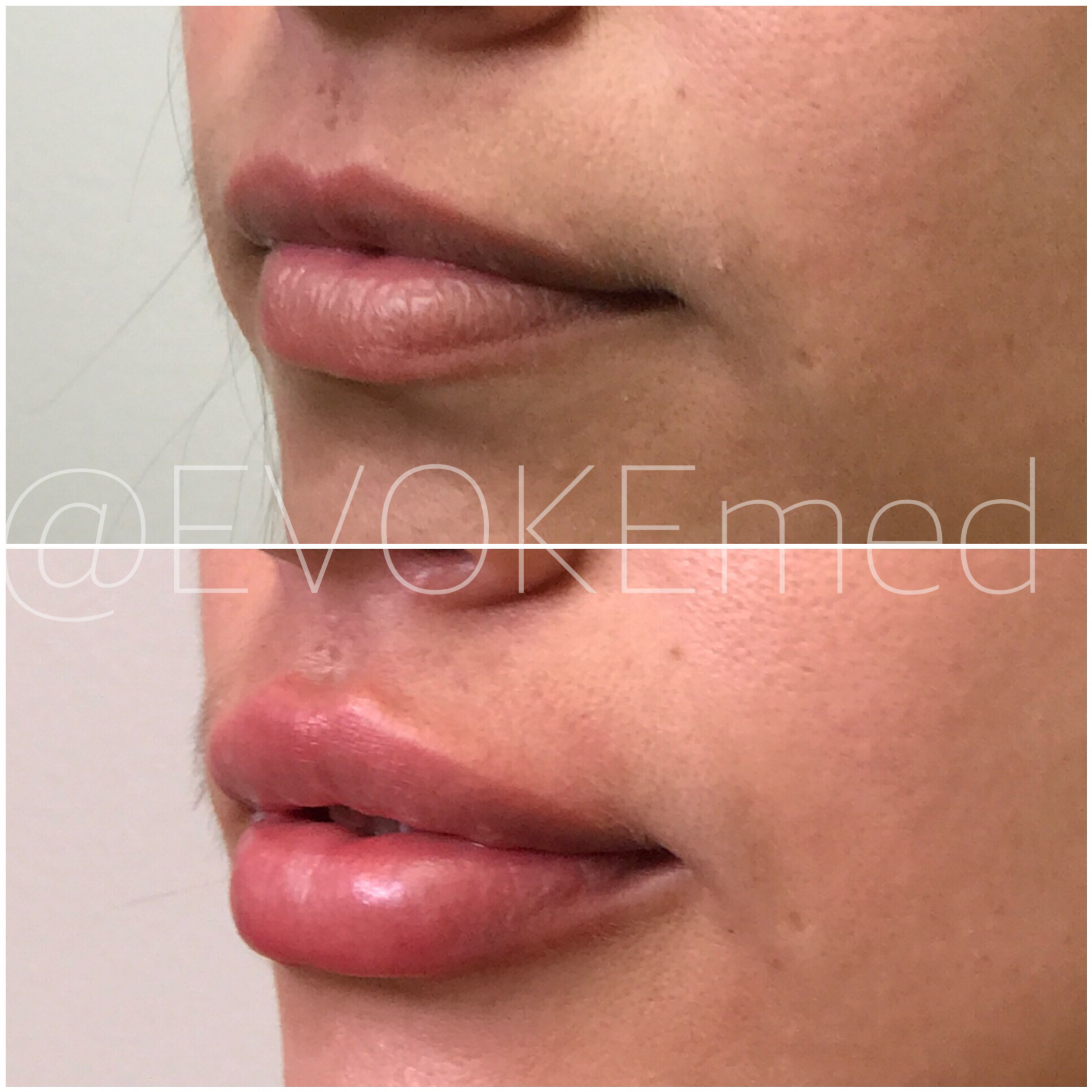 Lip Augmentation with Filler