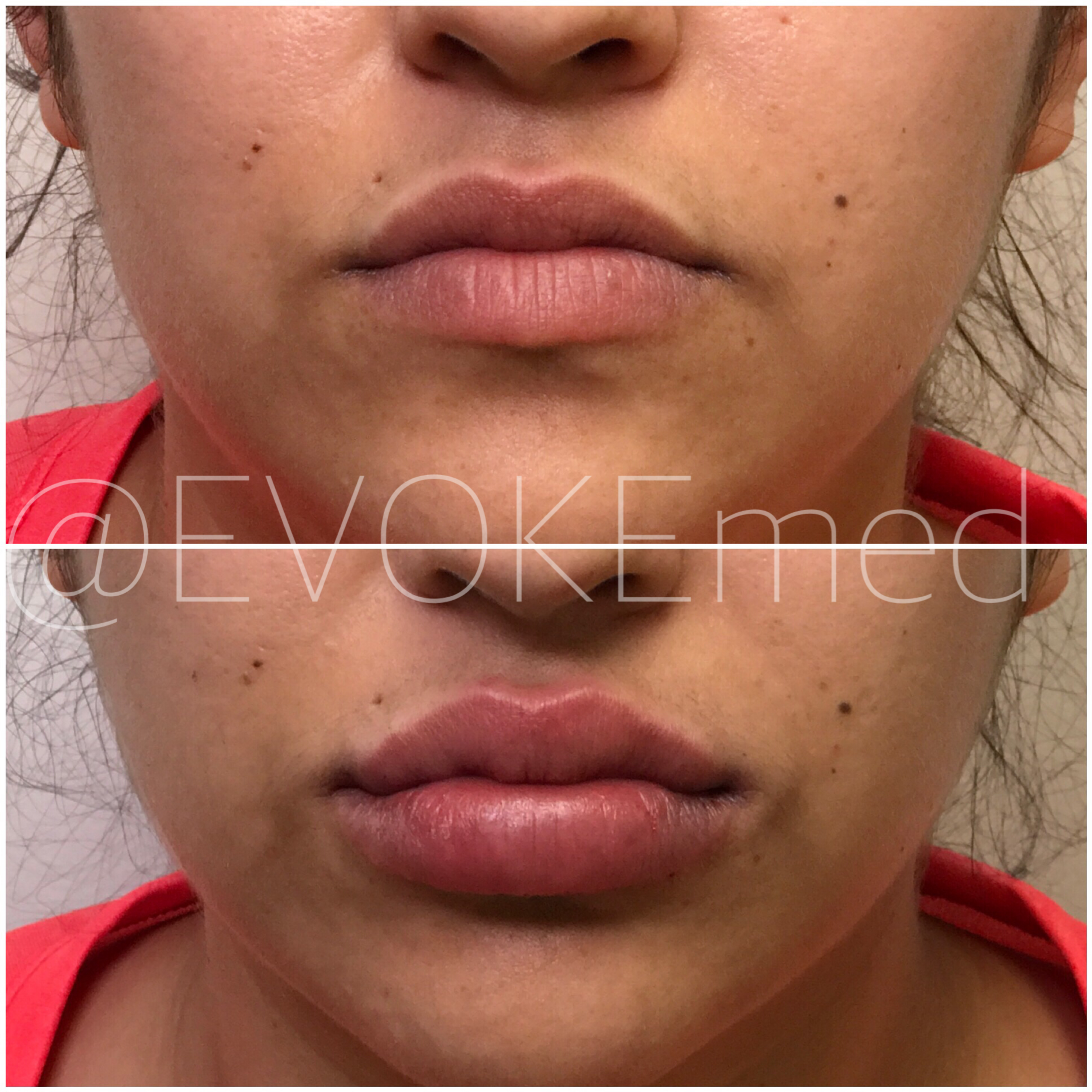 Lip Augmentation with Filler