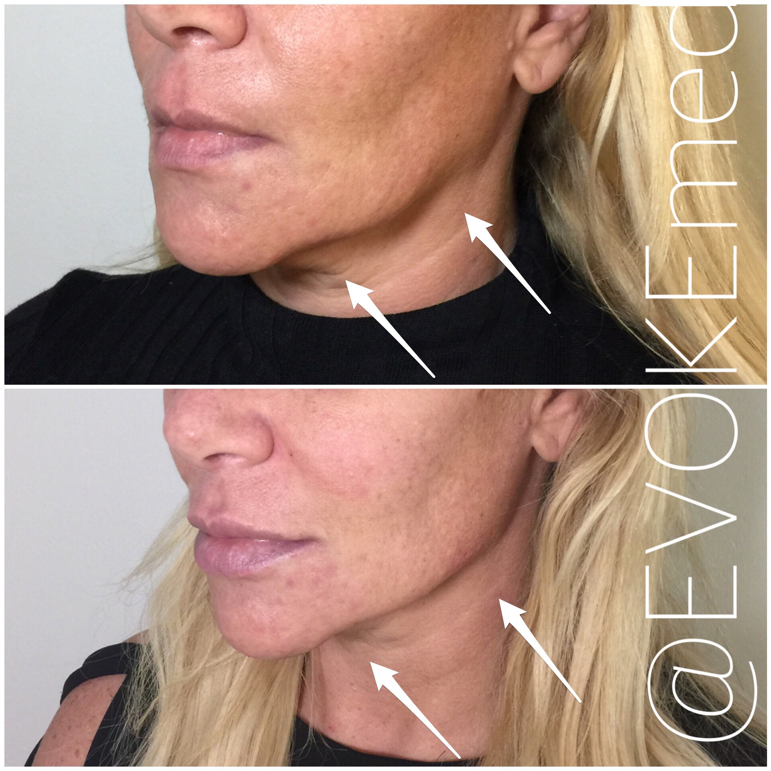 Chin Augmentation and Jawline Contouring with Filler