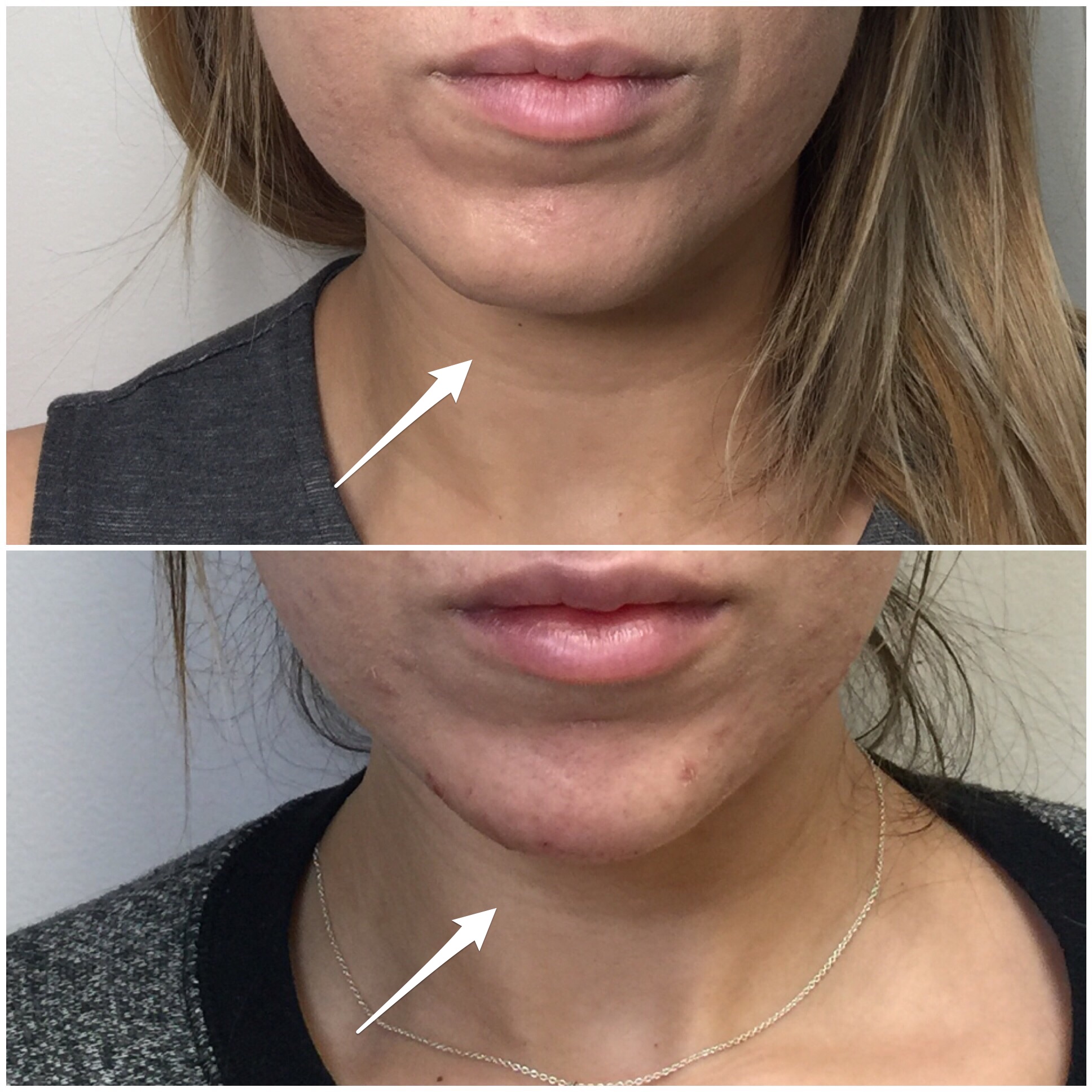 Chin Augmentation with Filler 