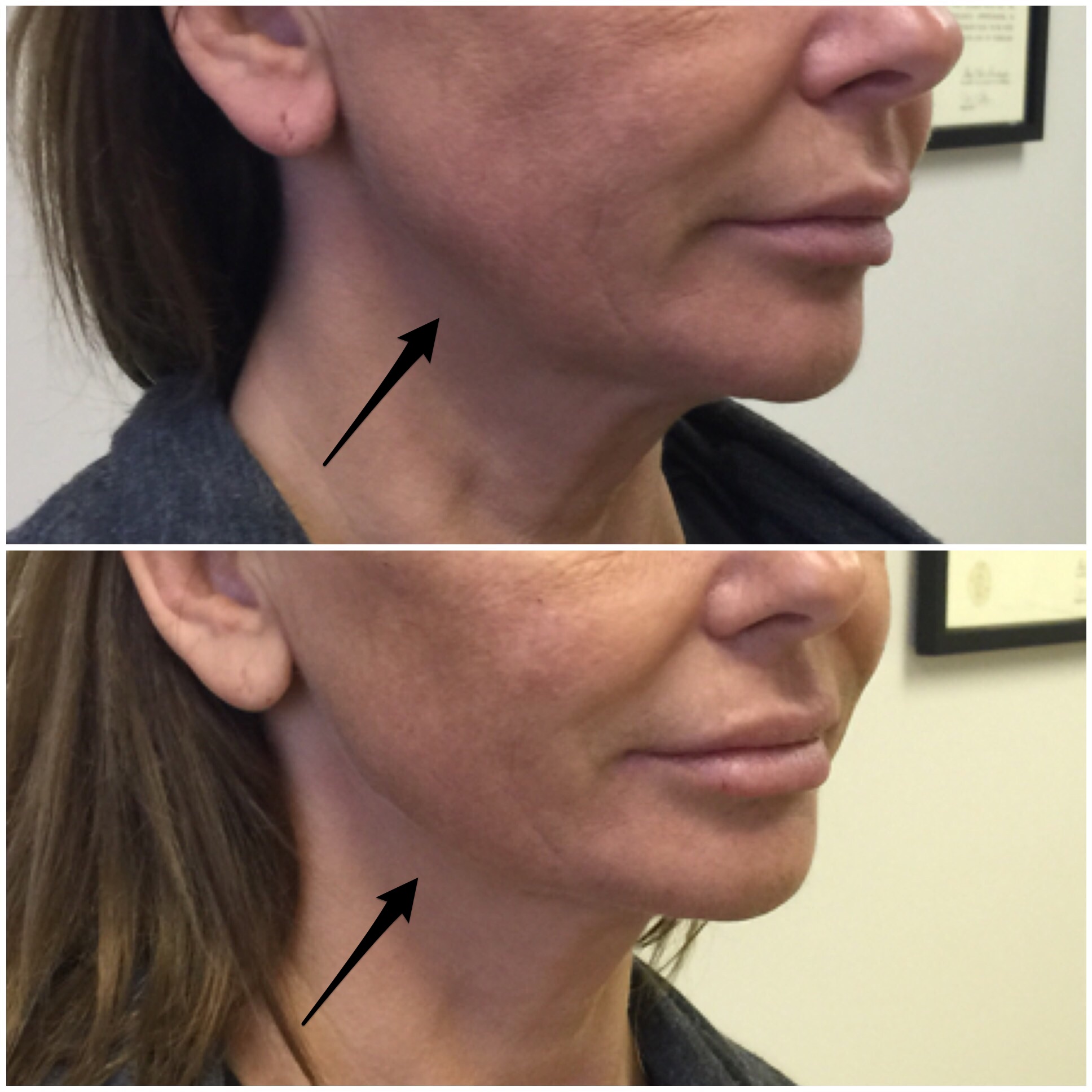 Jawline Contouring with Filler