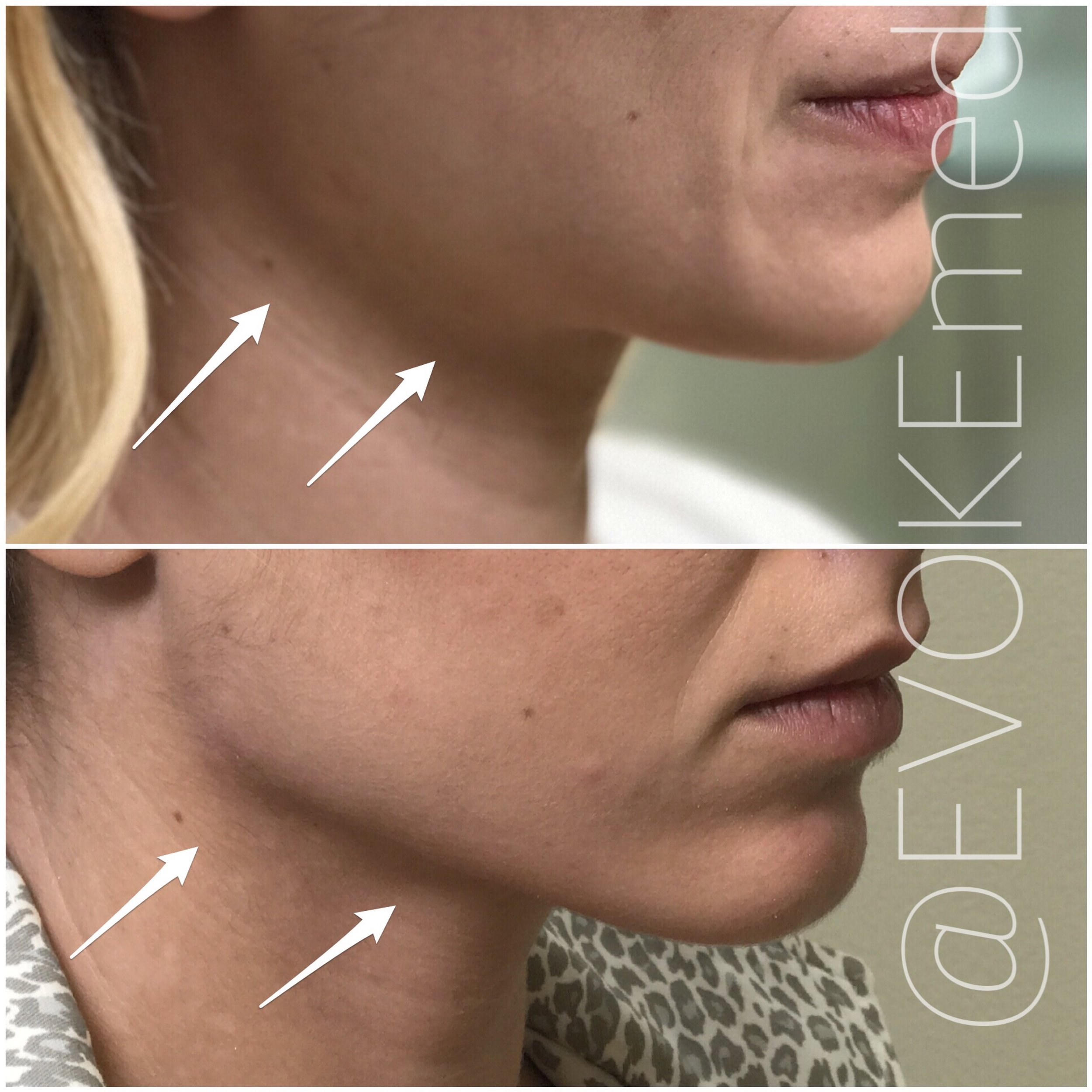 Jawline Contouring with Filler