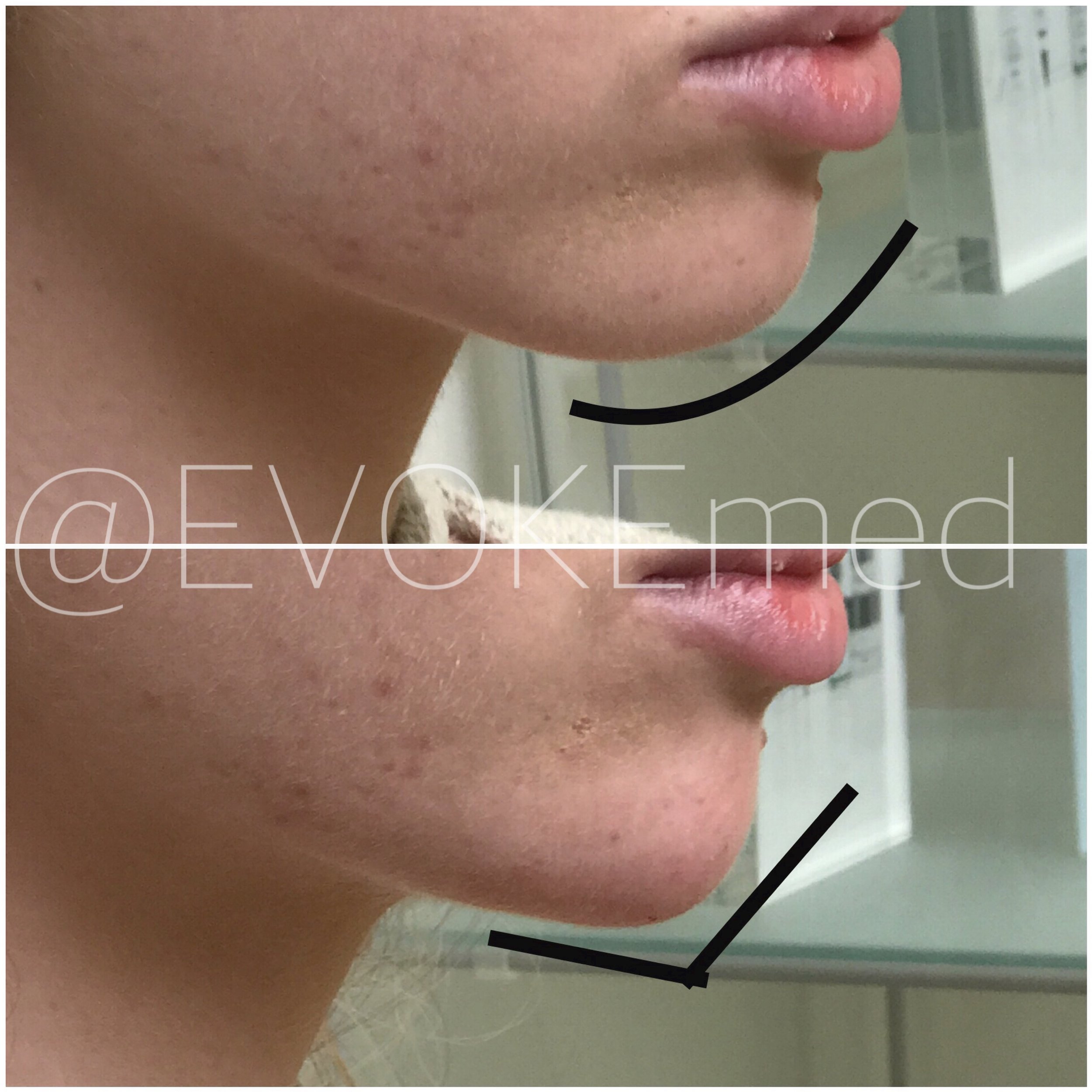 Chin Augmentation with Filler