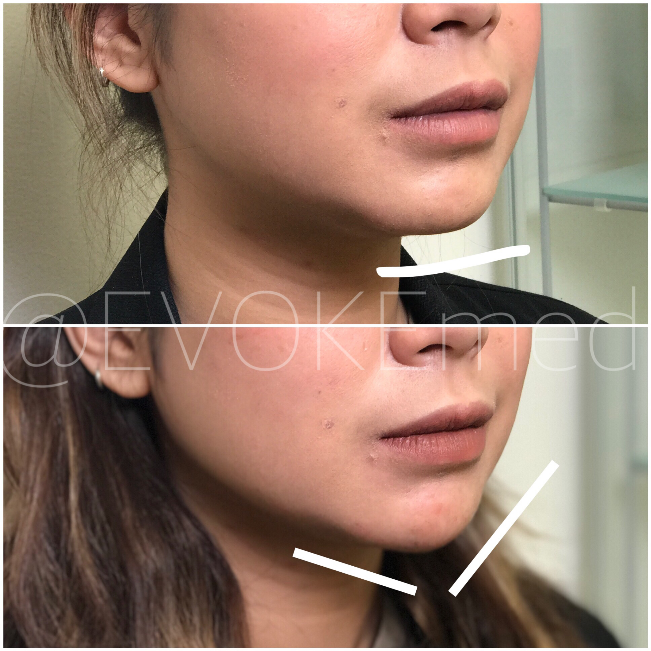 Chin Augmentation with Filler