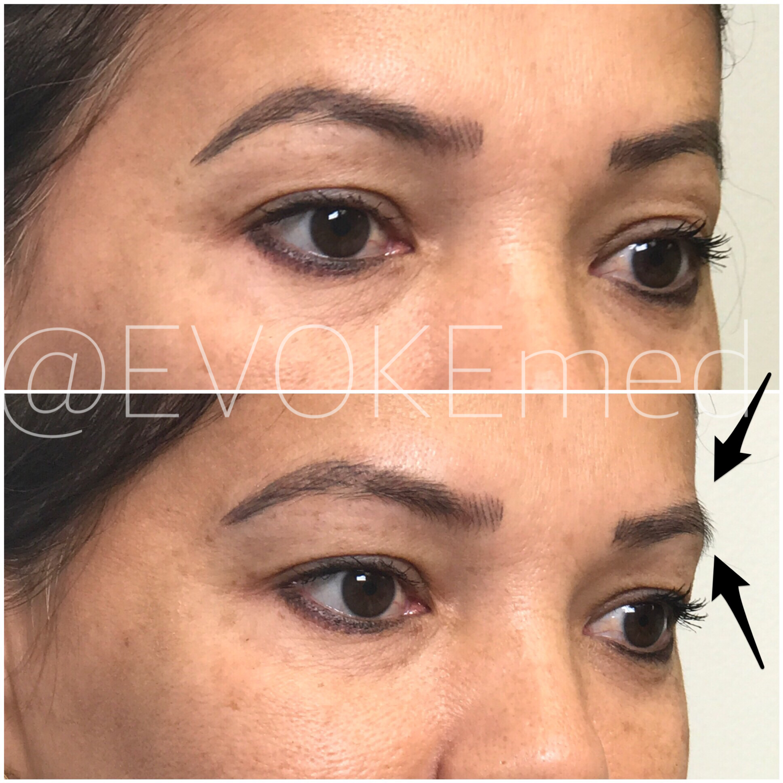 Brow Lift with Filler