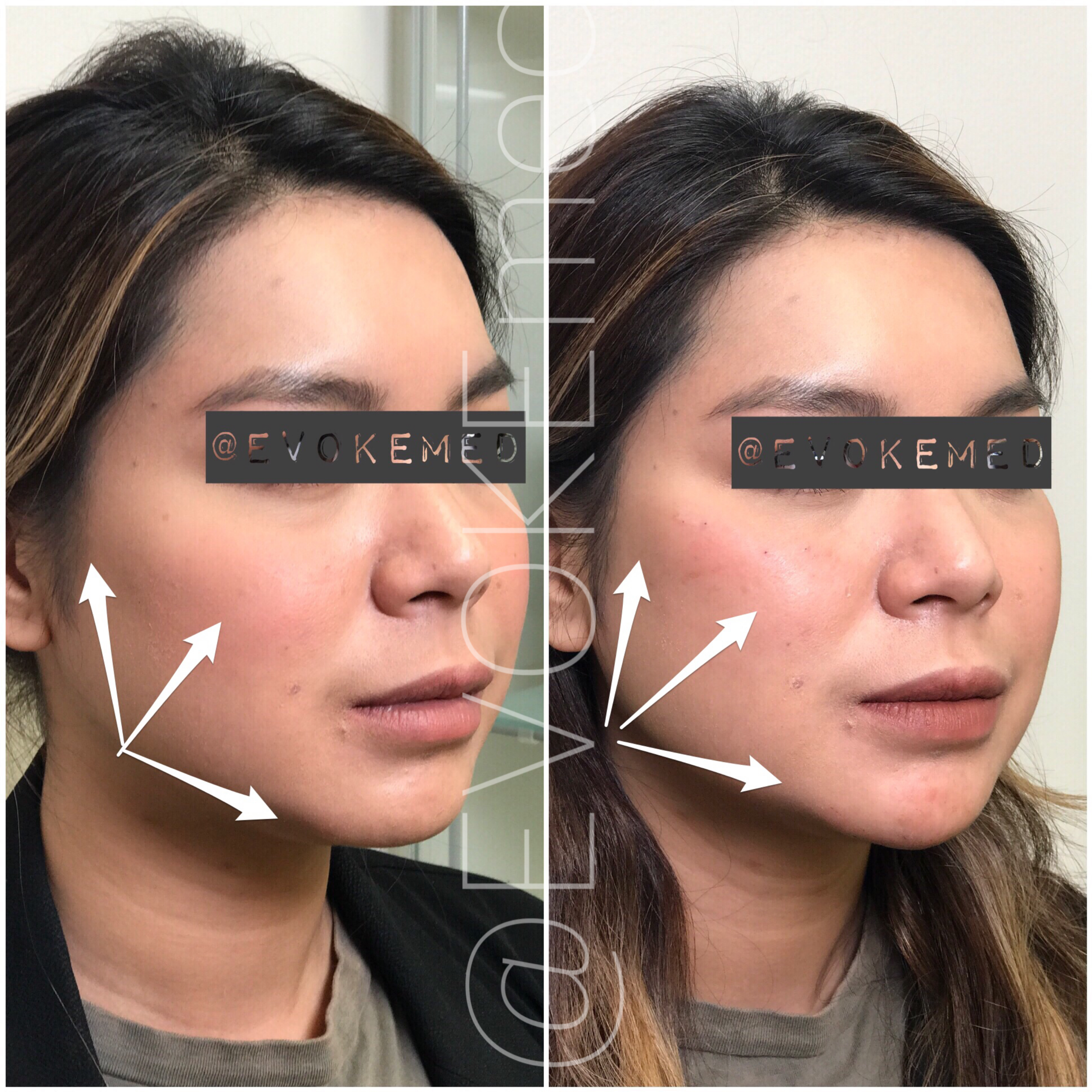 Facial Contouring with Filler