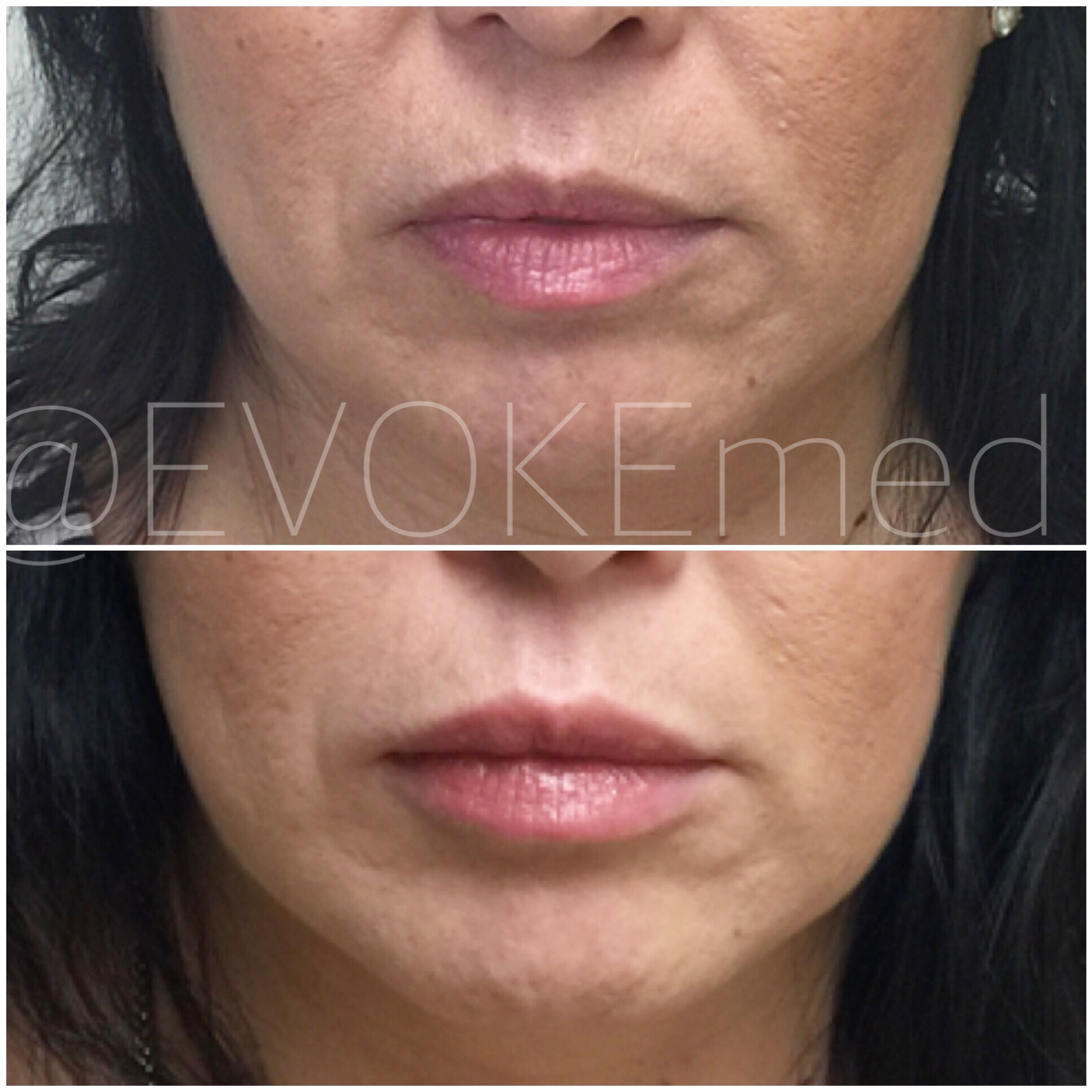 Anti-Aging Lip Augmentation with Filler