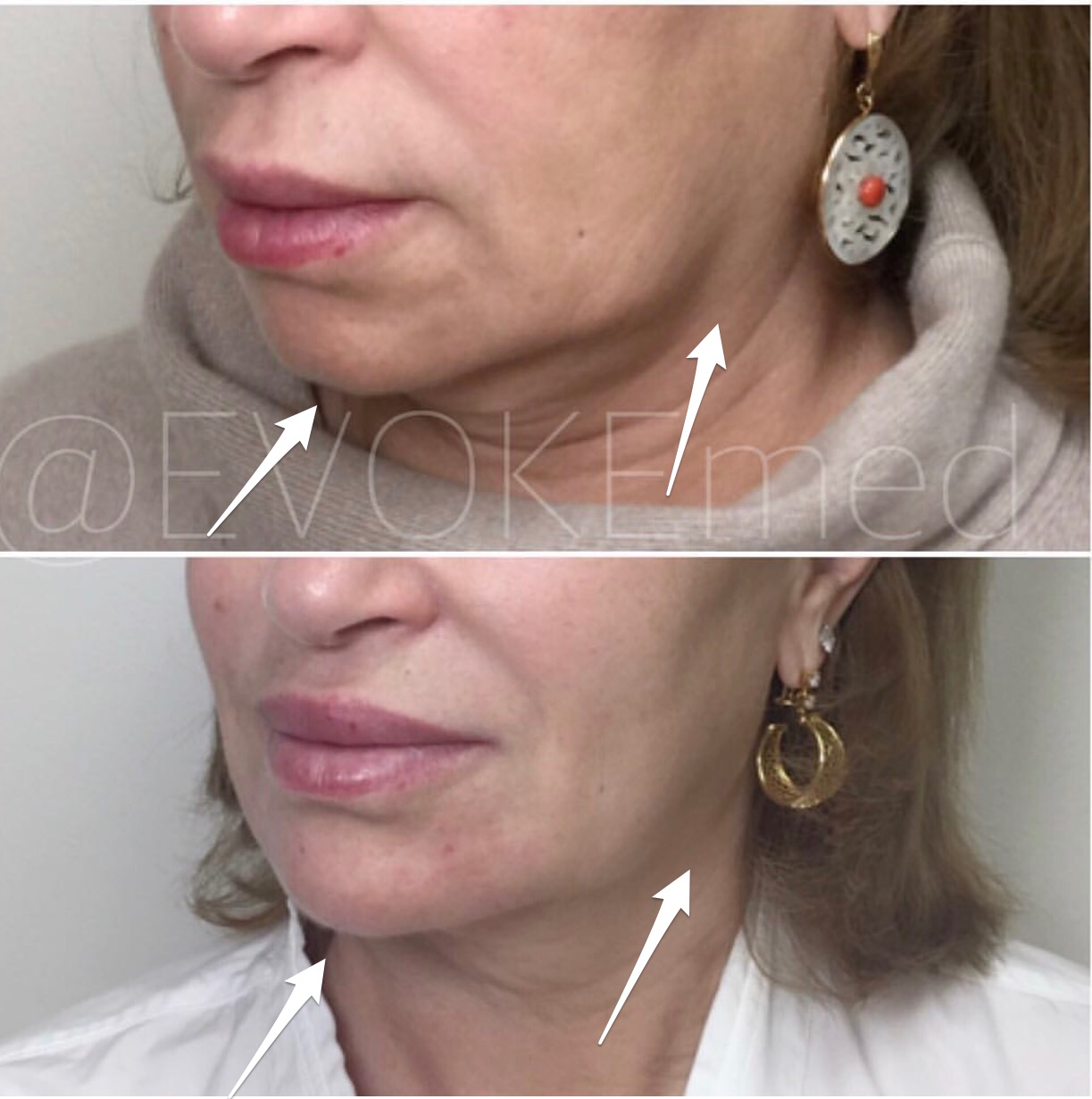 Jawline Contouring and Chin Augmentation with Filler