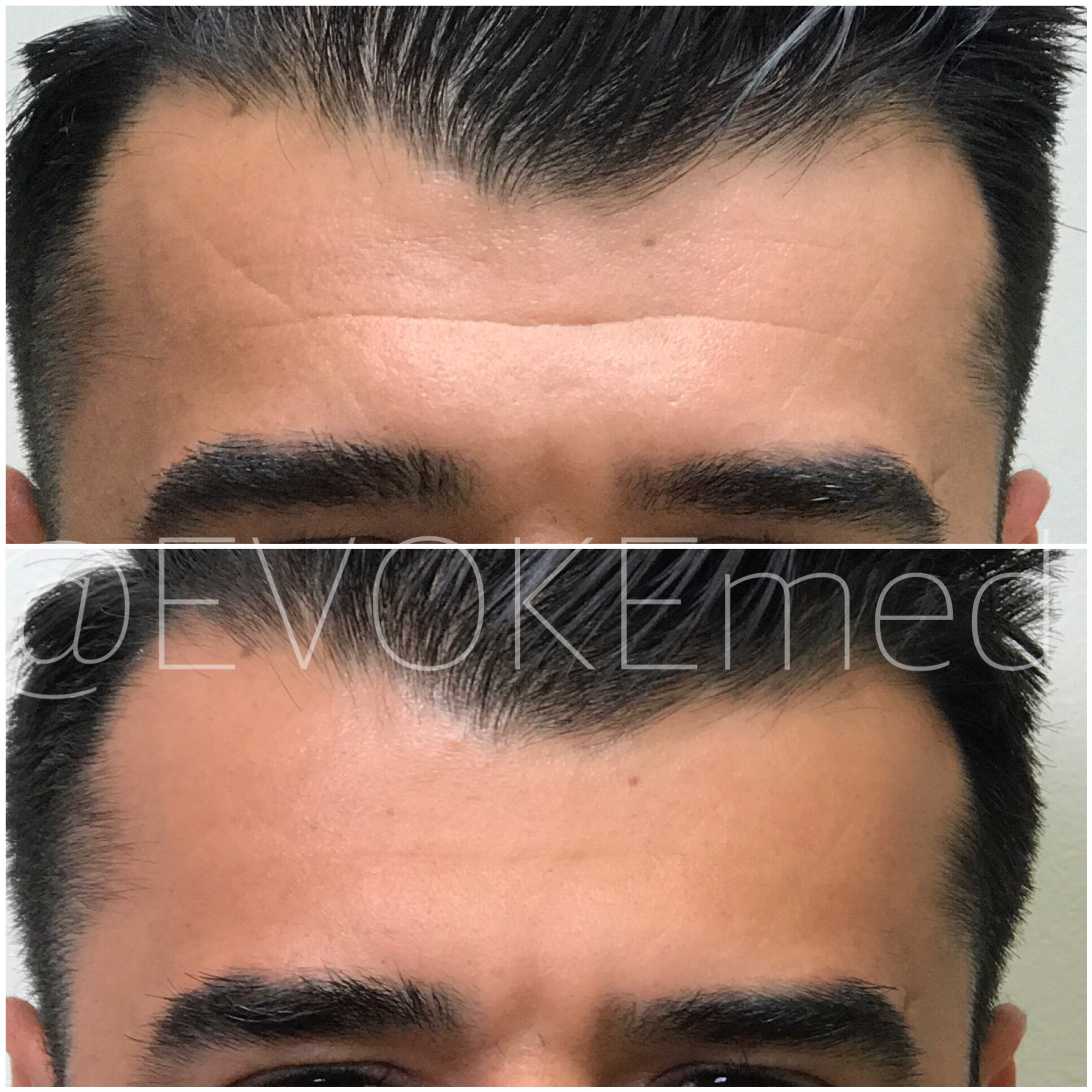 Botox Treatment for Men