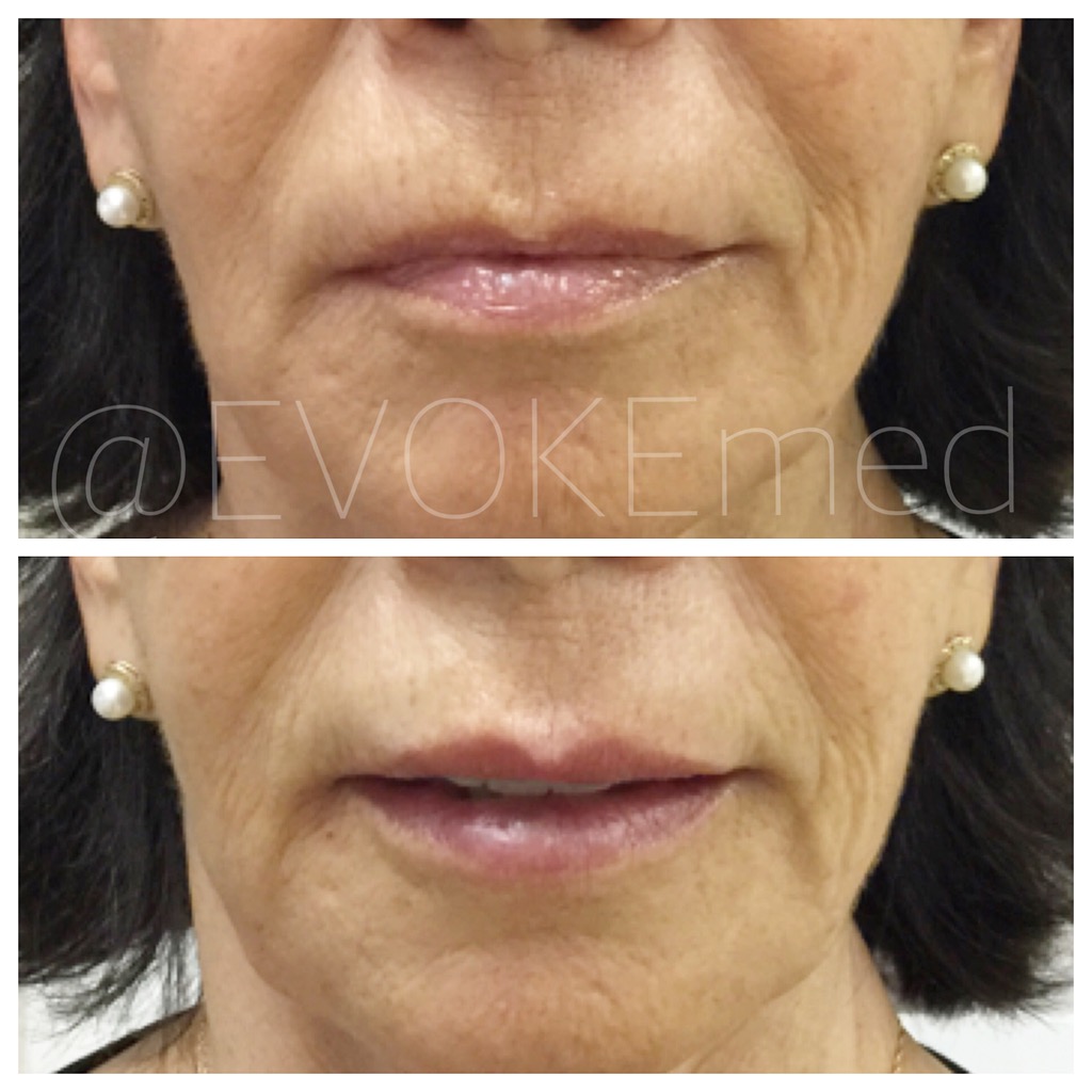 Anti-Aging Lip Augmentation with Filler
