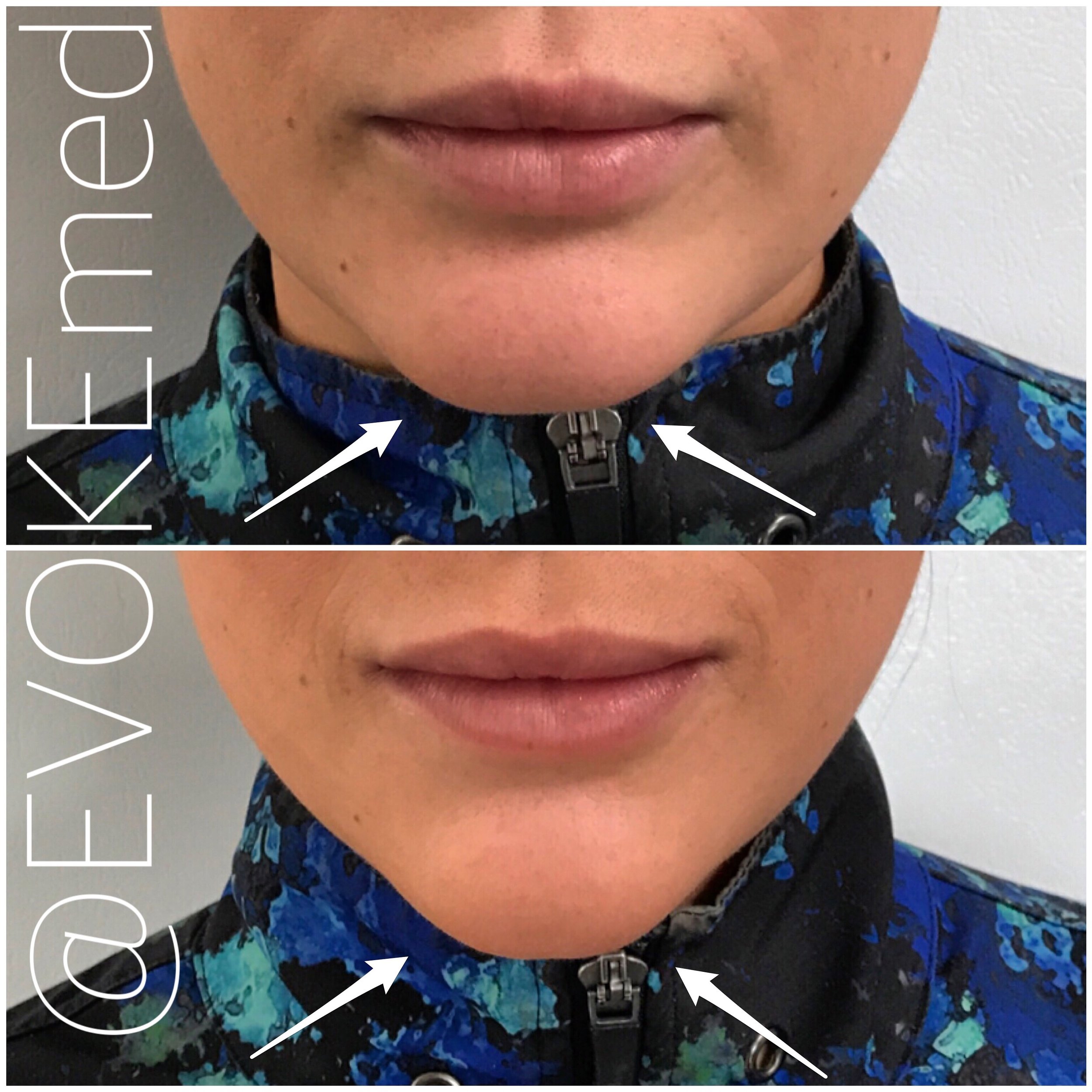 Chin Augmentation with Filler