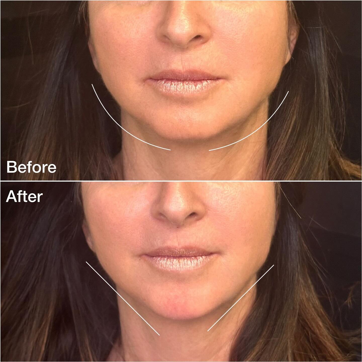 A little bit of chin filler is a game changer!! 💉 This is my regular patient as of recently she felt that her lower face started to appear a little bit more heavy, she noticed some jowling as well as irregular jawline contour. 
 
Her individual trea